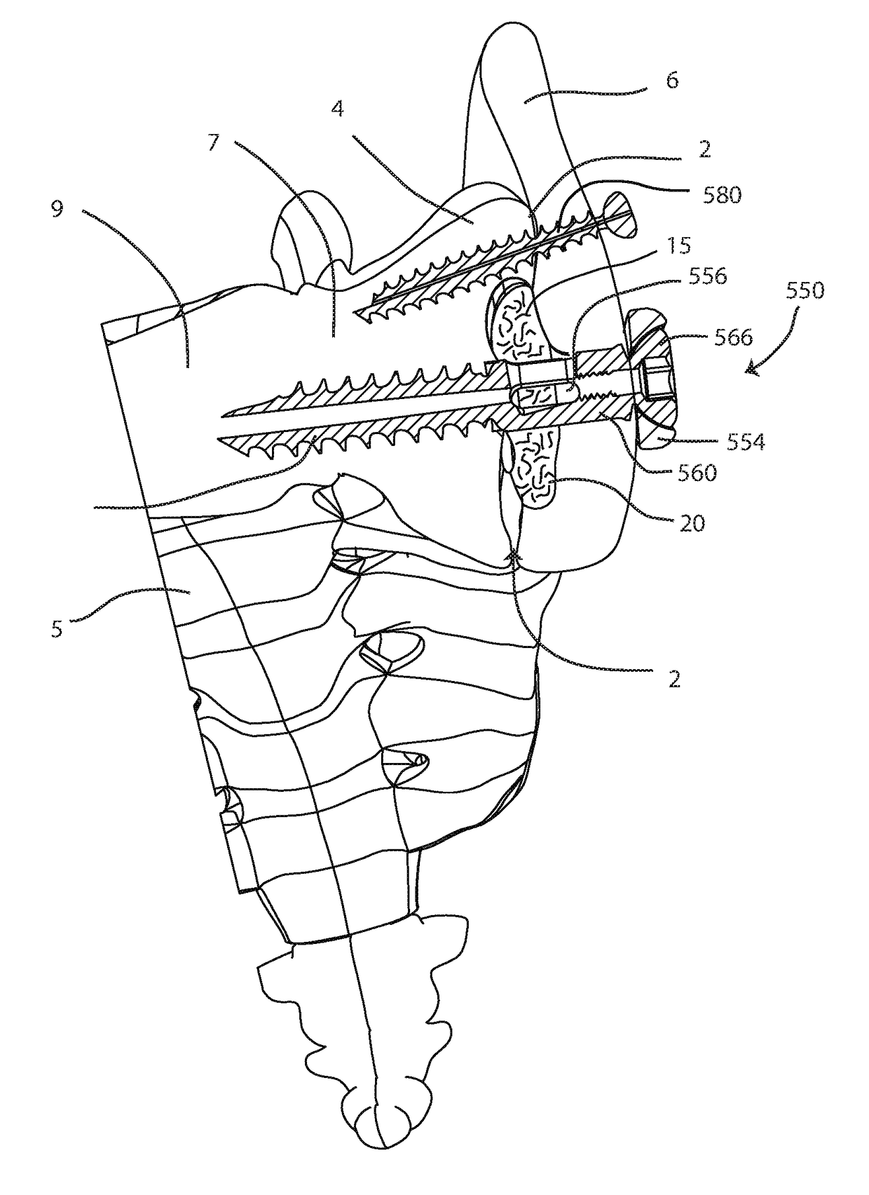 Joint fusion instrumentation and methods