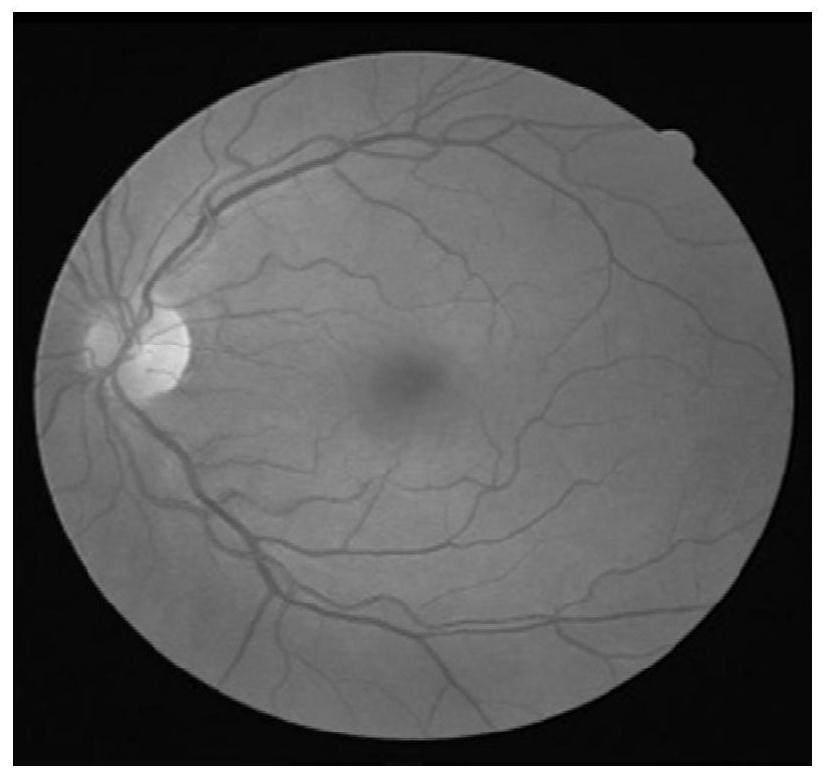 Retina optic disc segmentation method combining U-Net and region growing PCNN