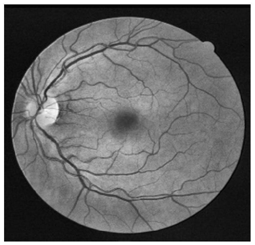 Retina optic disc segmentation method combining U-Net and region growing PCNN