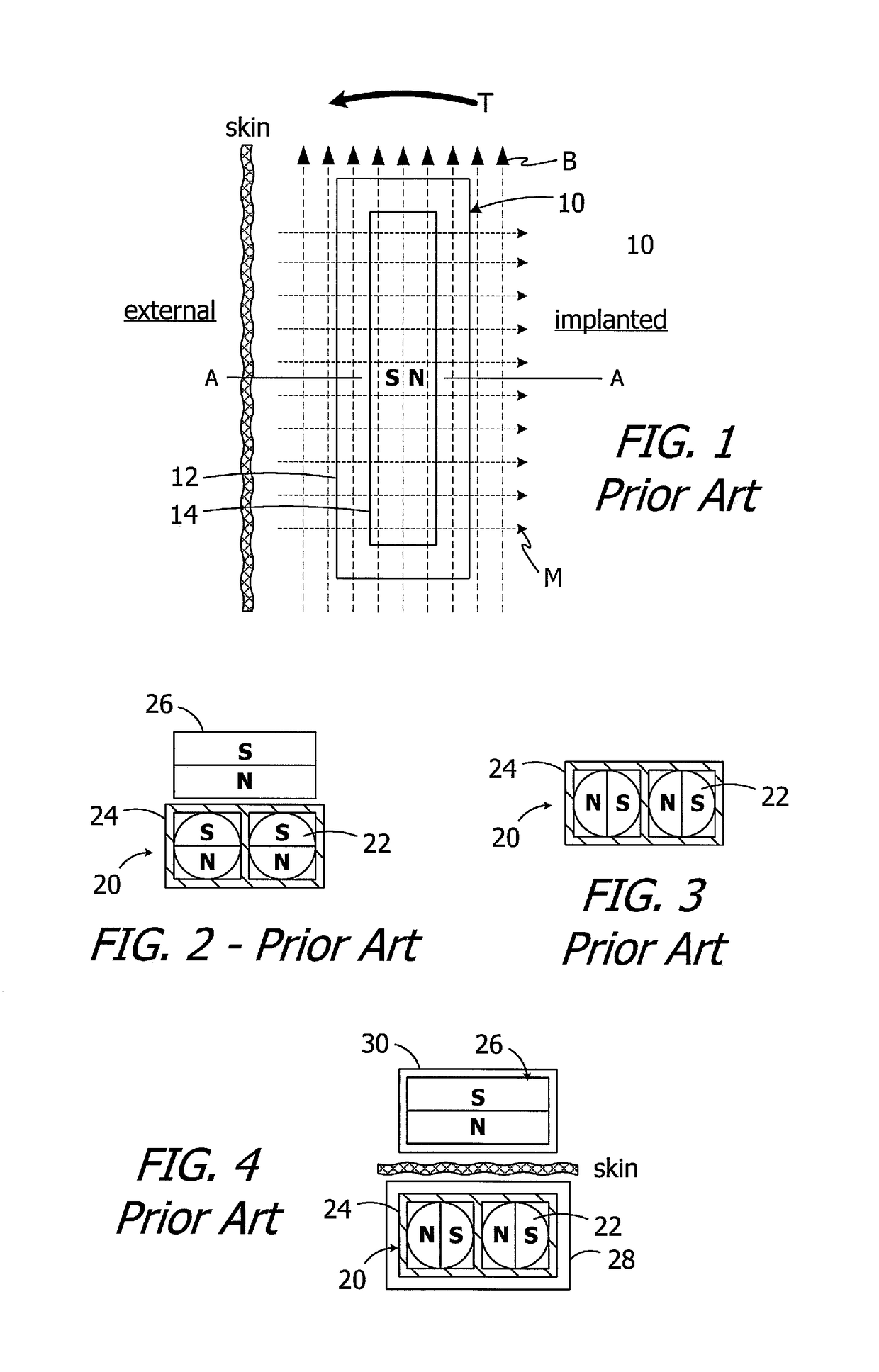 Cochlear implants having mri-compatible magnet apparatus and associated methods