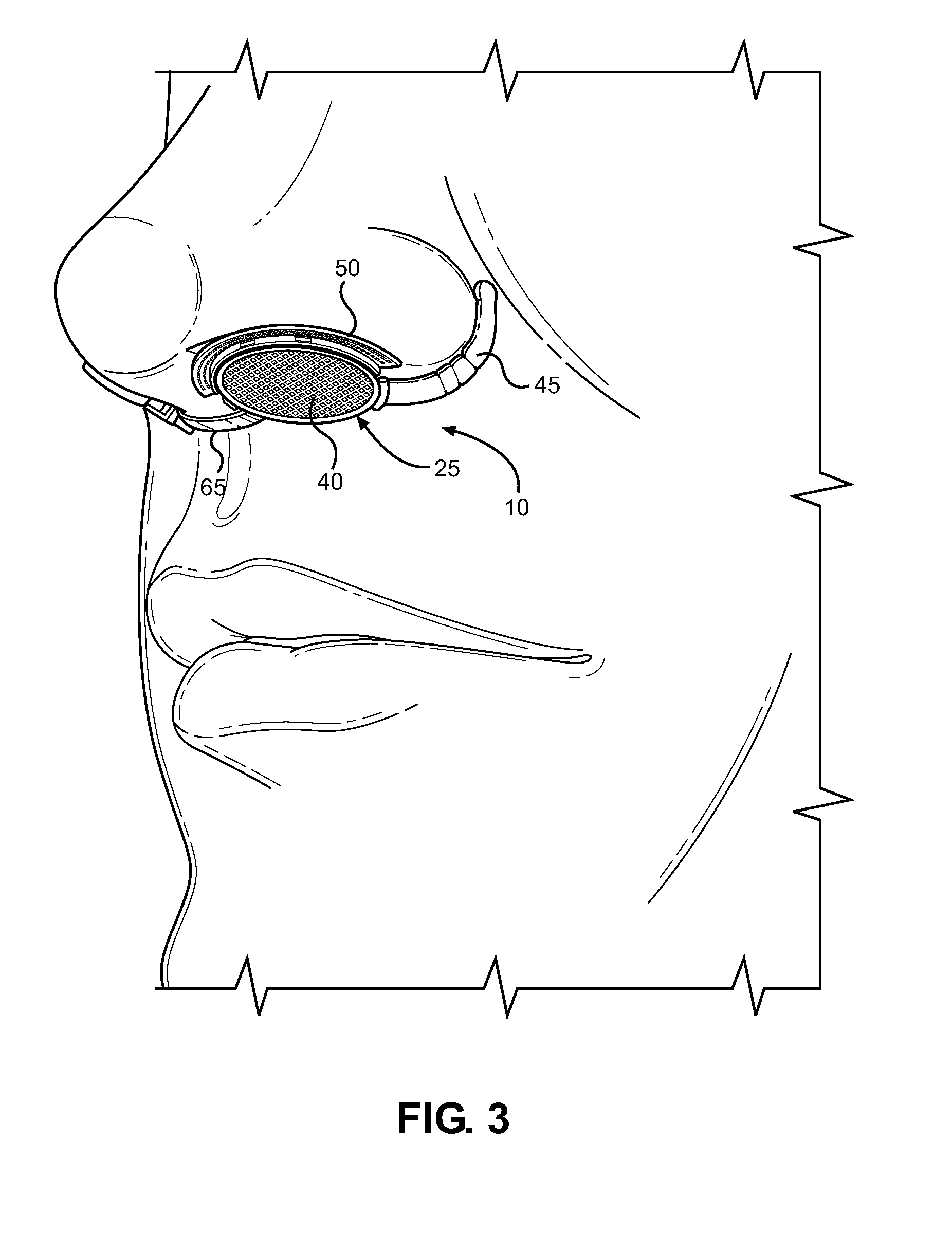 Nostril Filtration Assembly