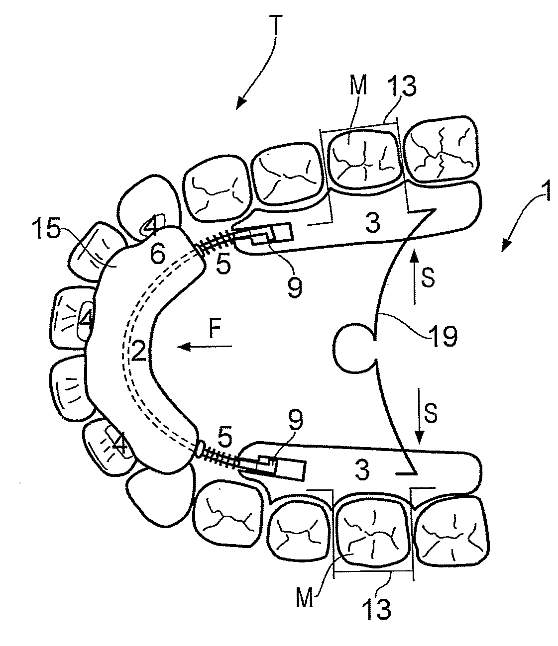 Orthodontic teeth positioning appliances