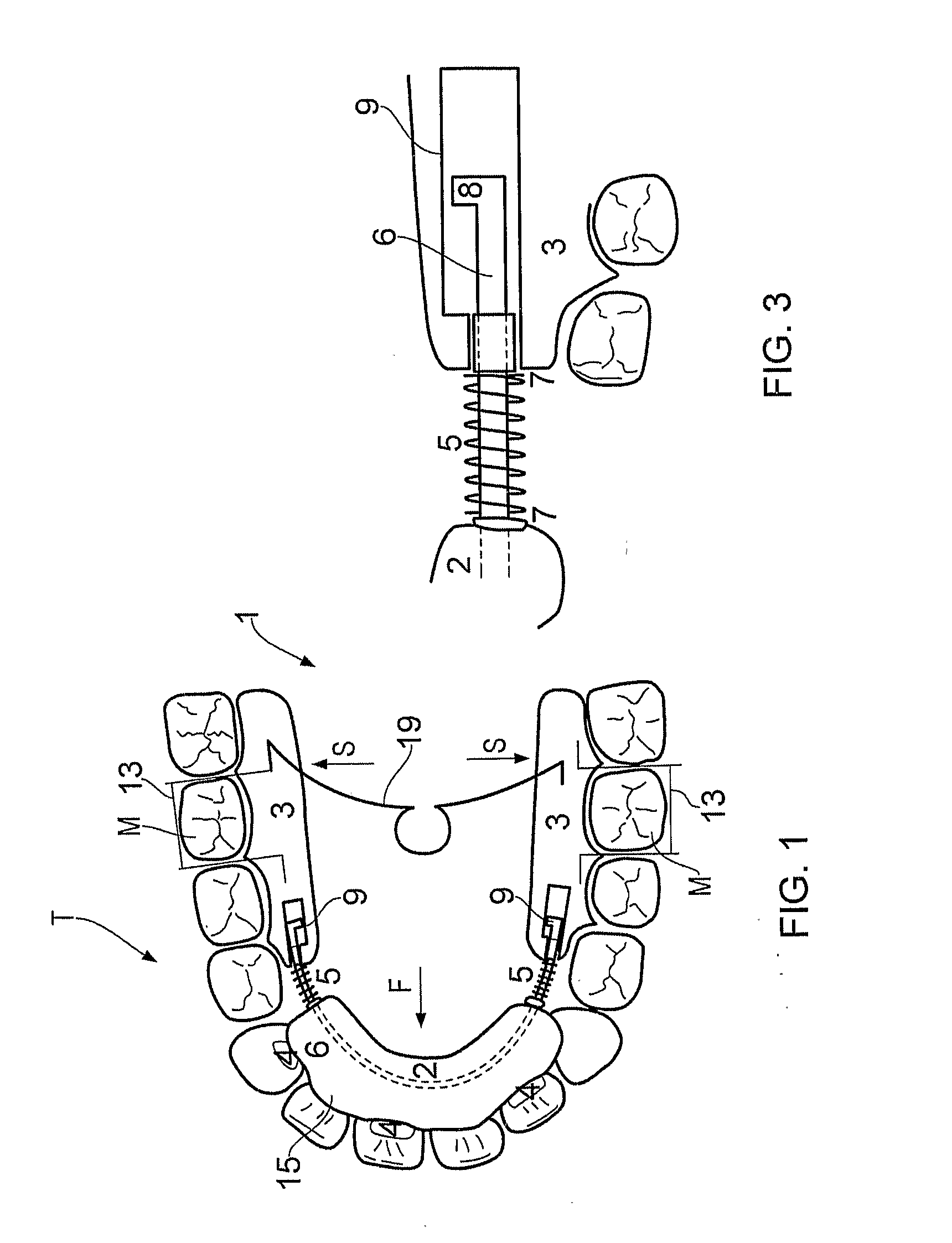 Orthodontic teeth positioning appliances