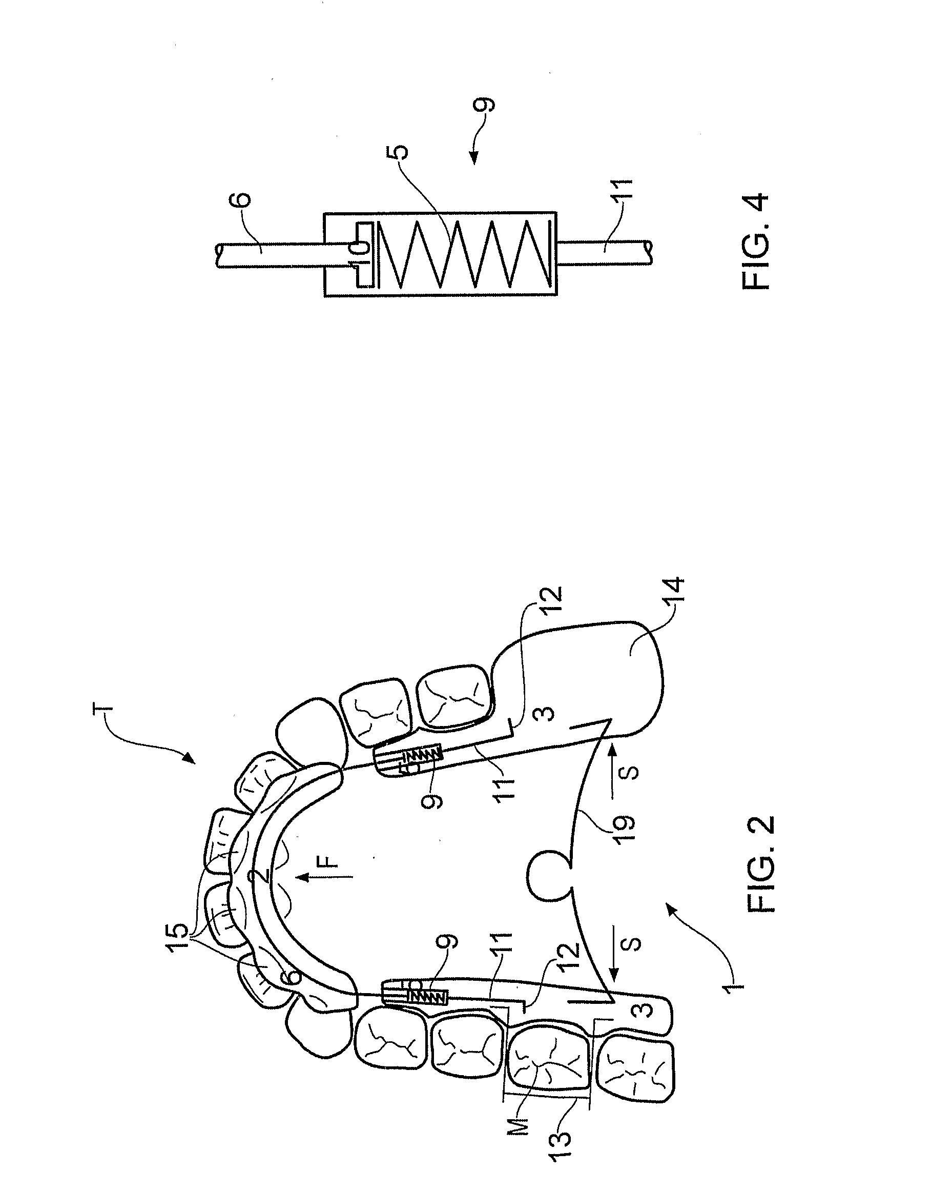 Orthodontic teeth positioning appliances