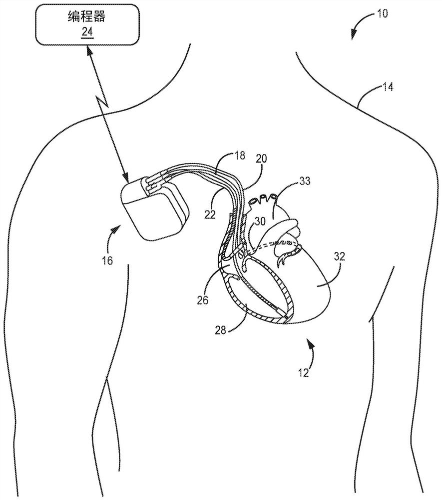 Monitoring of his bundle pacing capture during ventricular pacing therapy