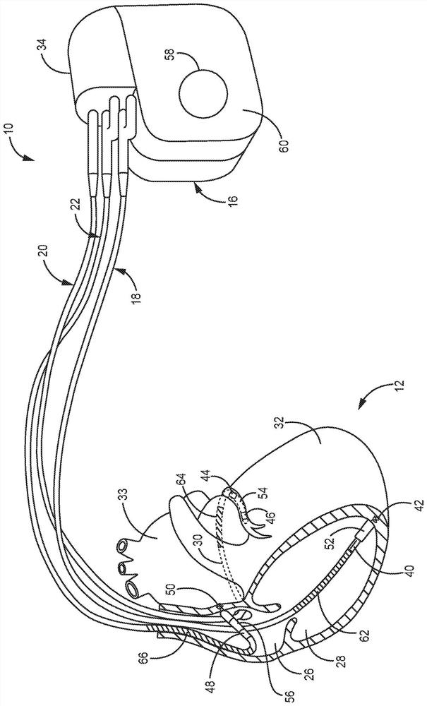 Monitoring of his bundle pacing capture during ventricular pacing therapy