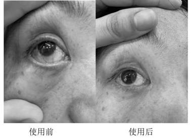 Application of polypeptide in medicine for treating eye inflammation