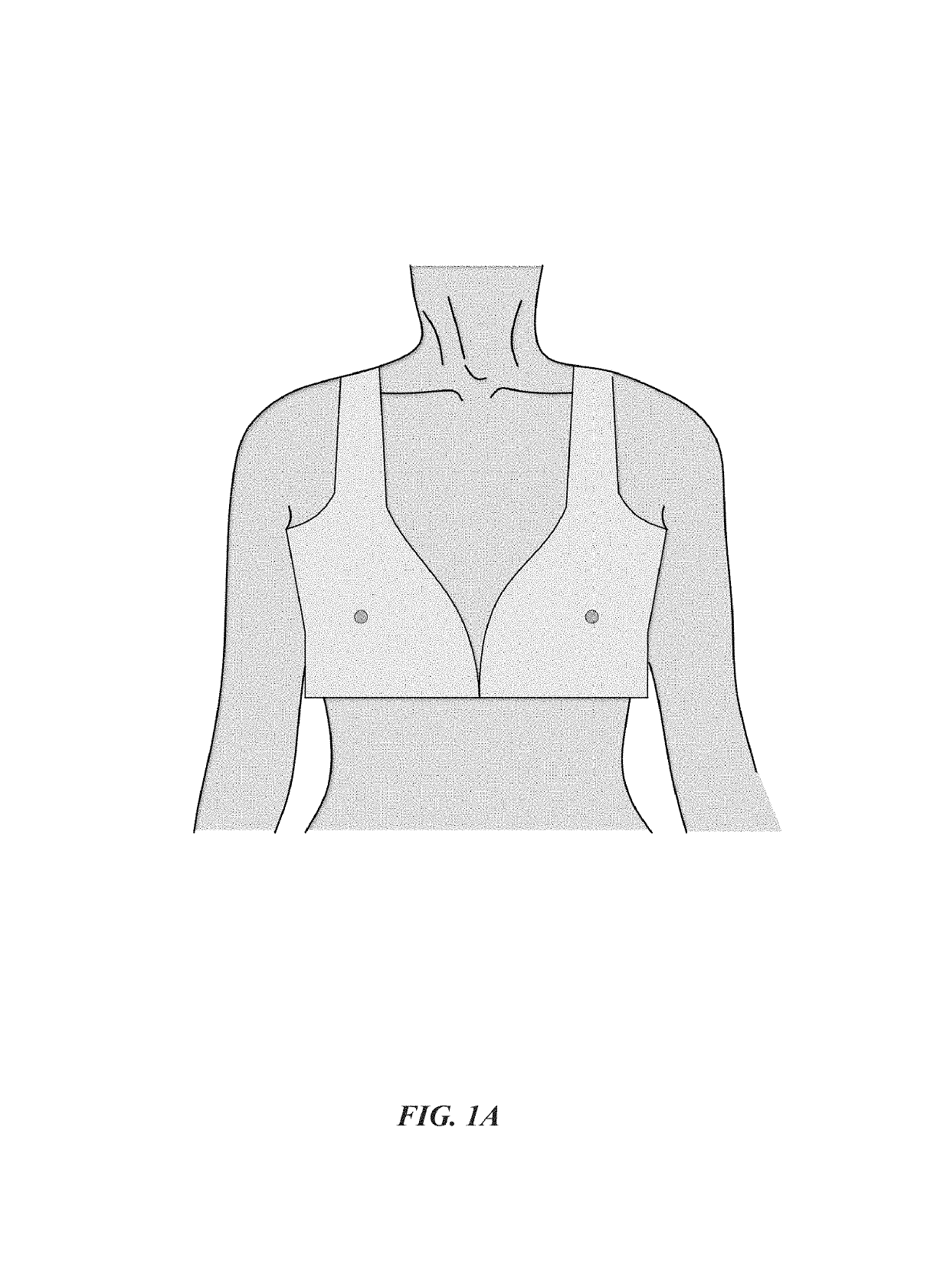 Hydrocolloid dressing for precise nipple positioning after nipple- or skin-sparing mastectomy