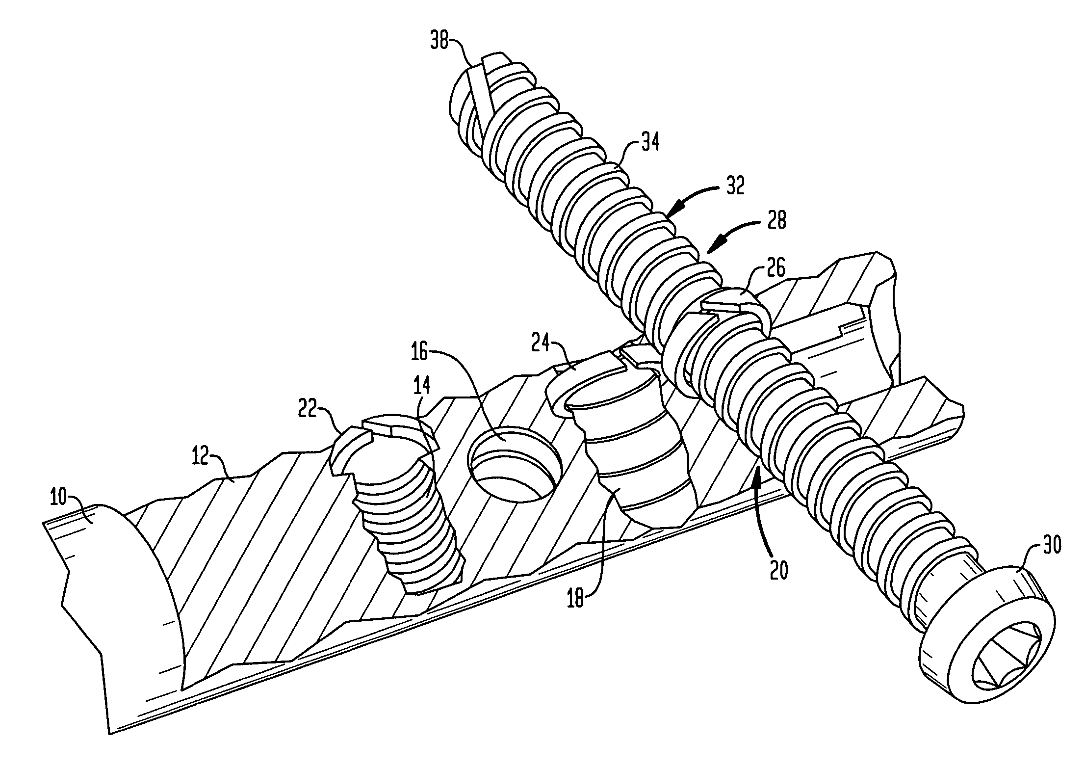 Implant for osteosynthesis