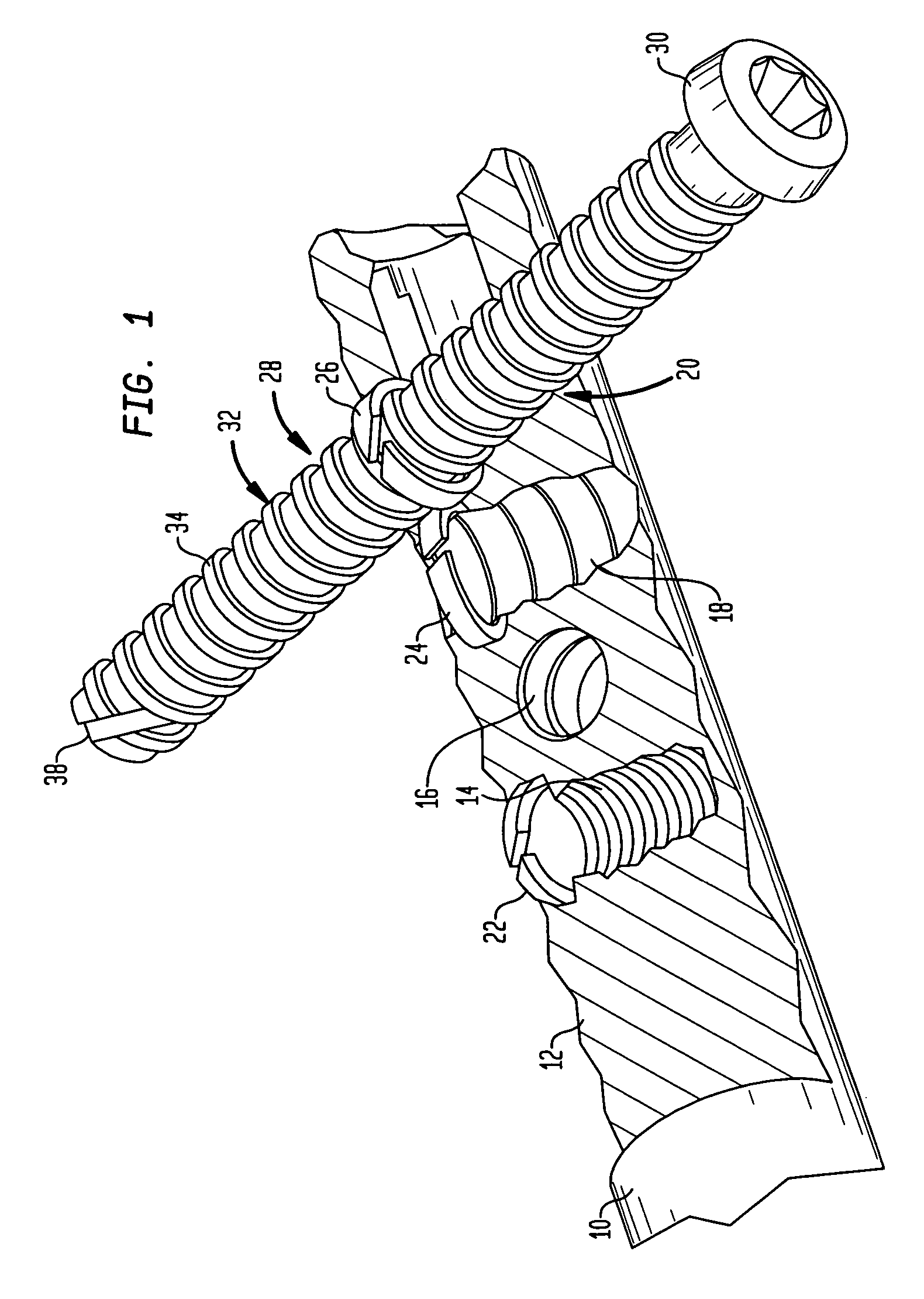 Implant for osteosynthesis