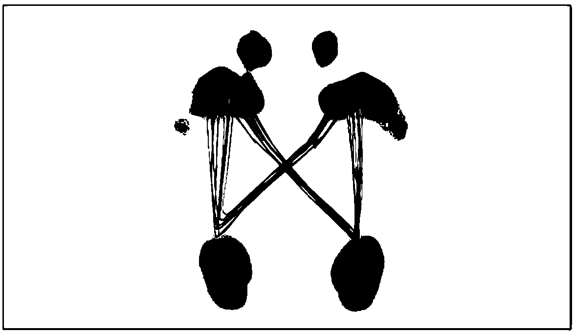 Method for evaluating gait mode of patient with unilateral achilles tendon rupture in rehabilitation period