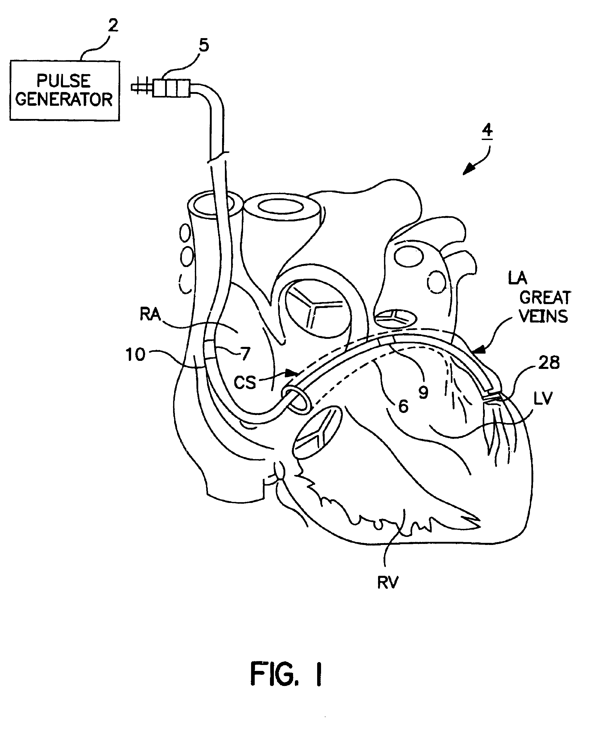 System and method for positioning an implantable medical device within a body