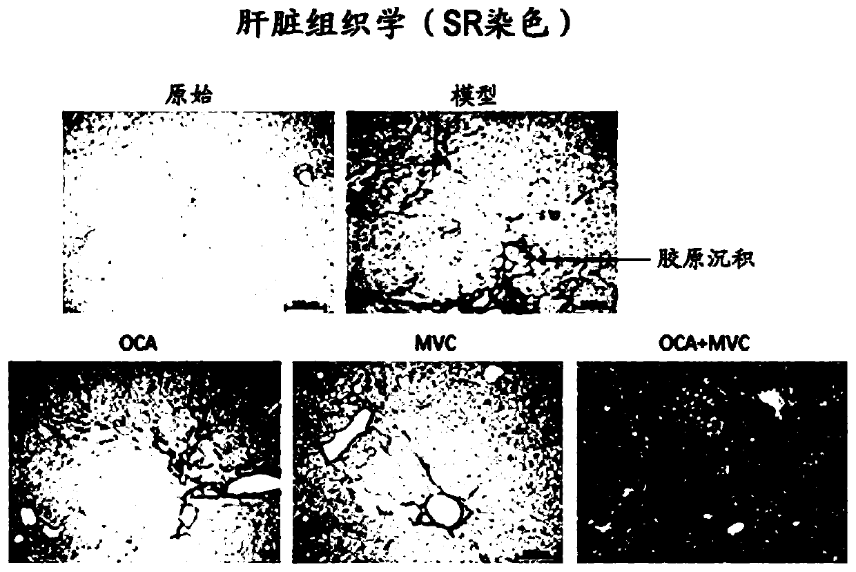 Combination therapy for nonalcoholic steatohepatitis (NASH) and liver fibrosis