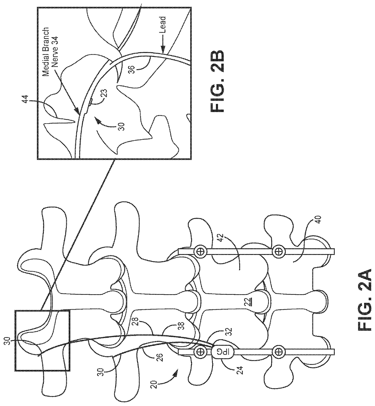 Systems, devices and methods for placement and fixation of neuromodulation system in combination with a laminectomy procedure