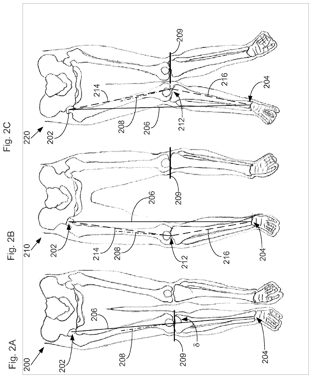 Surgical planning and method