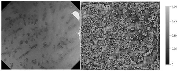 Deep detection network for quantifying esophageal mucosa IPCLs vascular morphological distribution