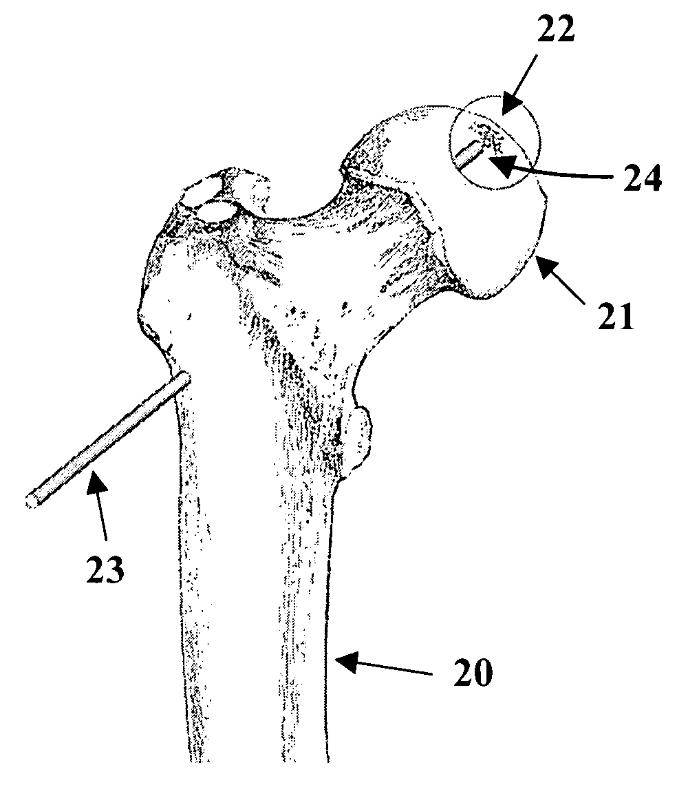 Method and composition for treating osteonecrosis and/or avascular necrosis