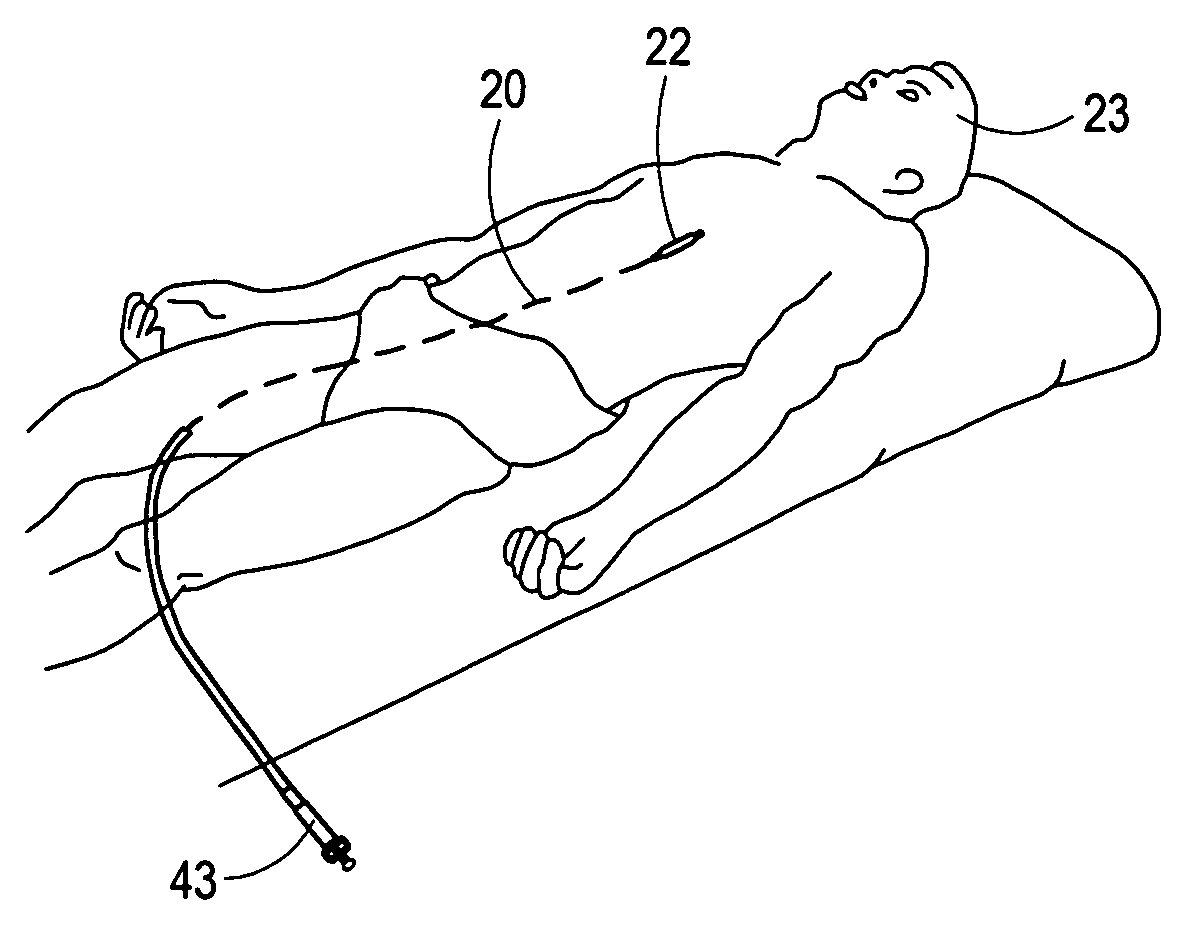 Directional cutting balloon