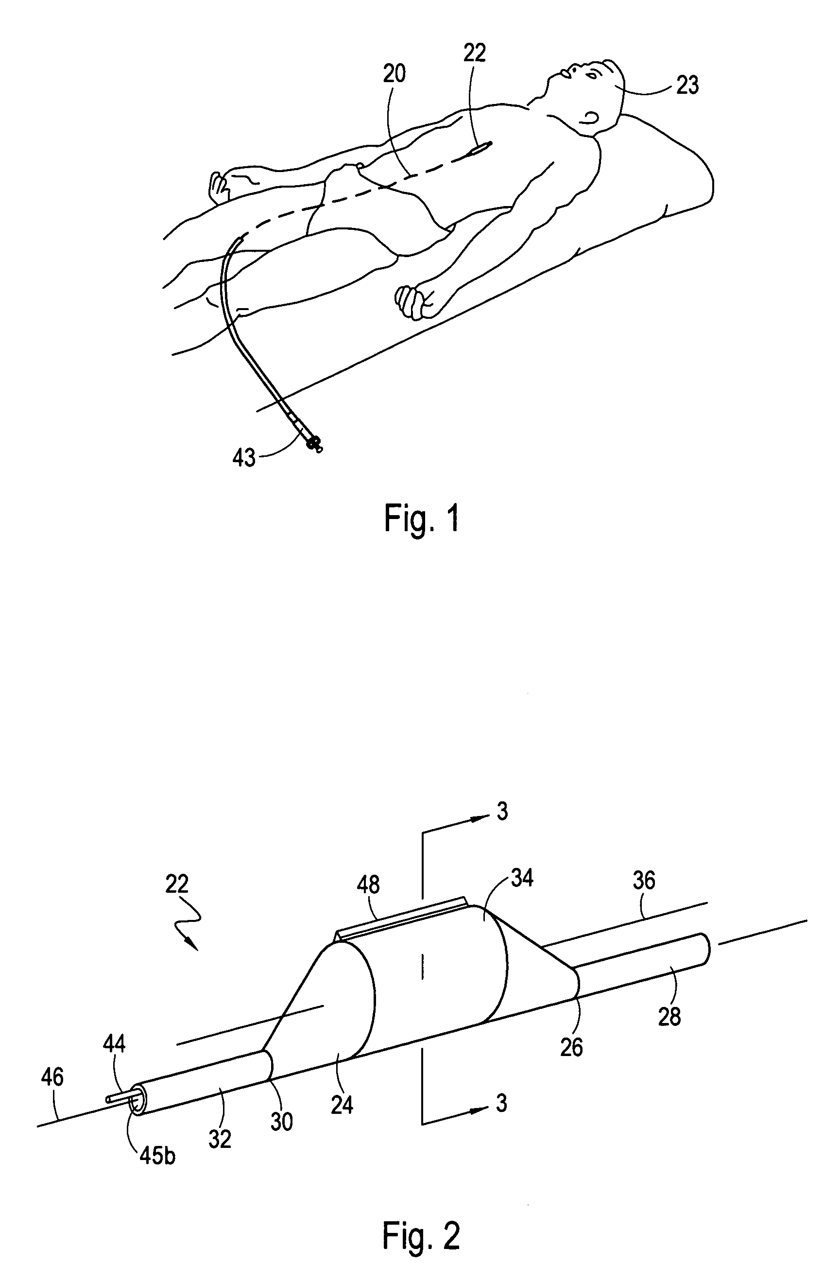 Directional cutting balloon