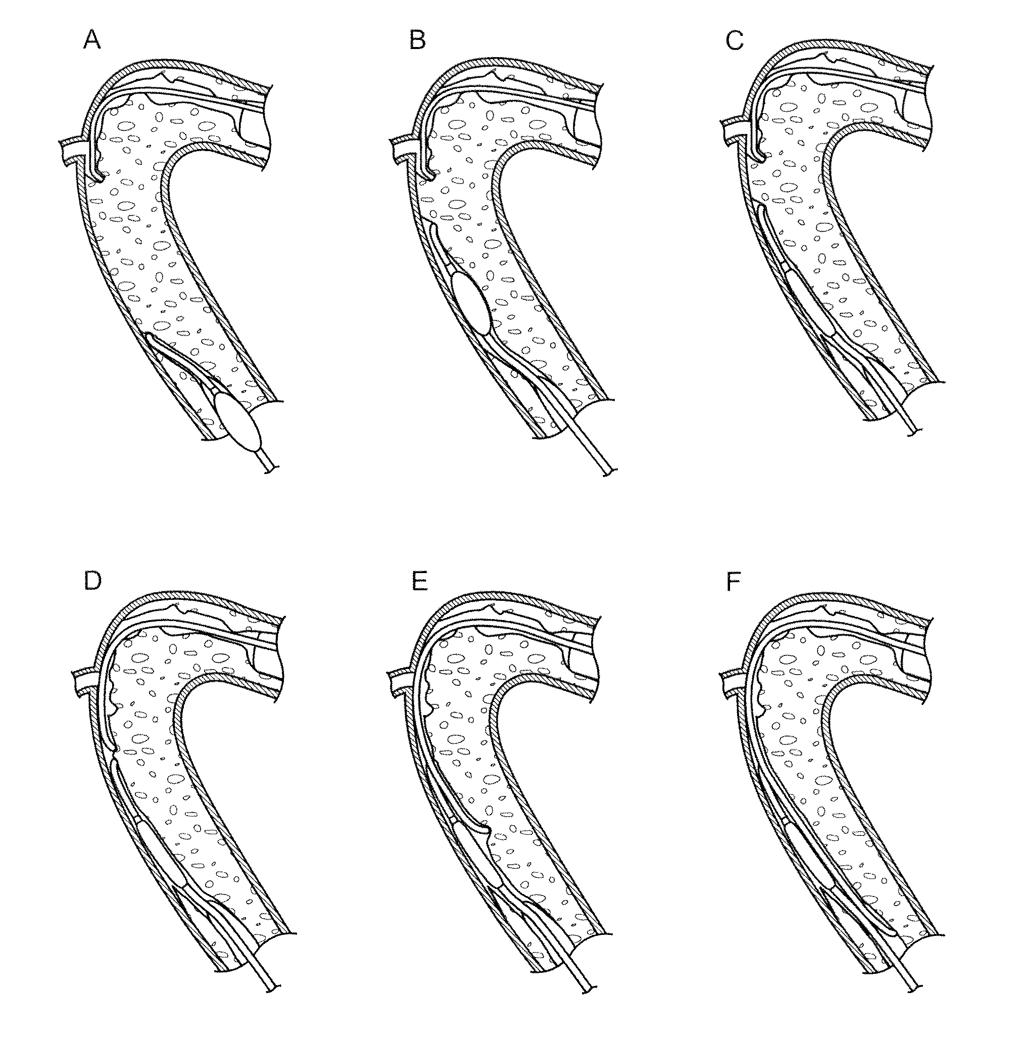 Recanalizing occluded vessels using controlled antegrade and retrograde tracking