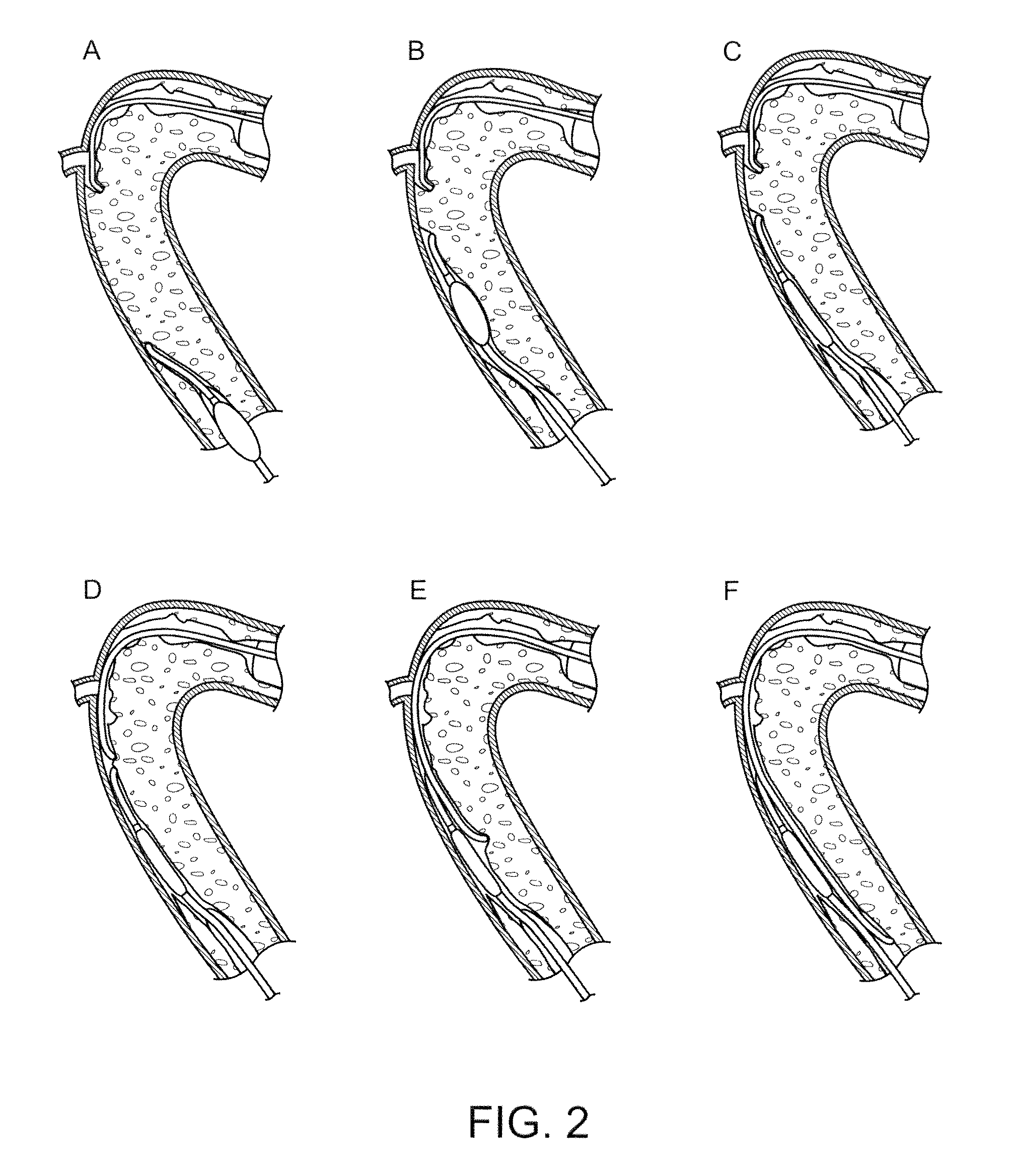 Recanalizing occluded vessels using controlled antegrade and retrograde tracking