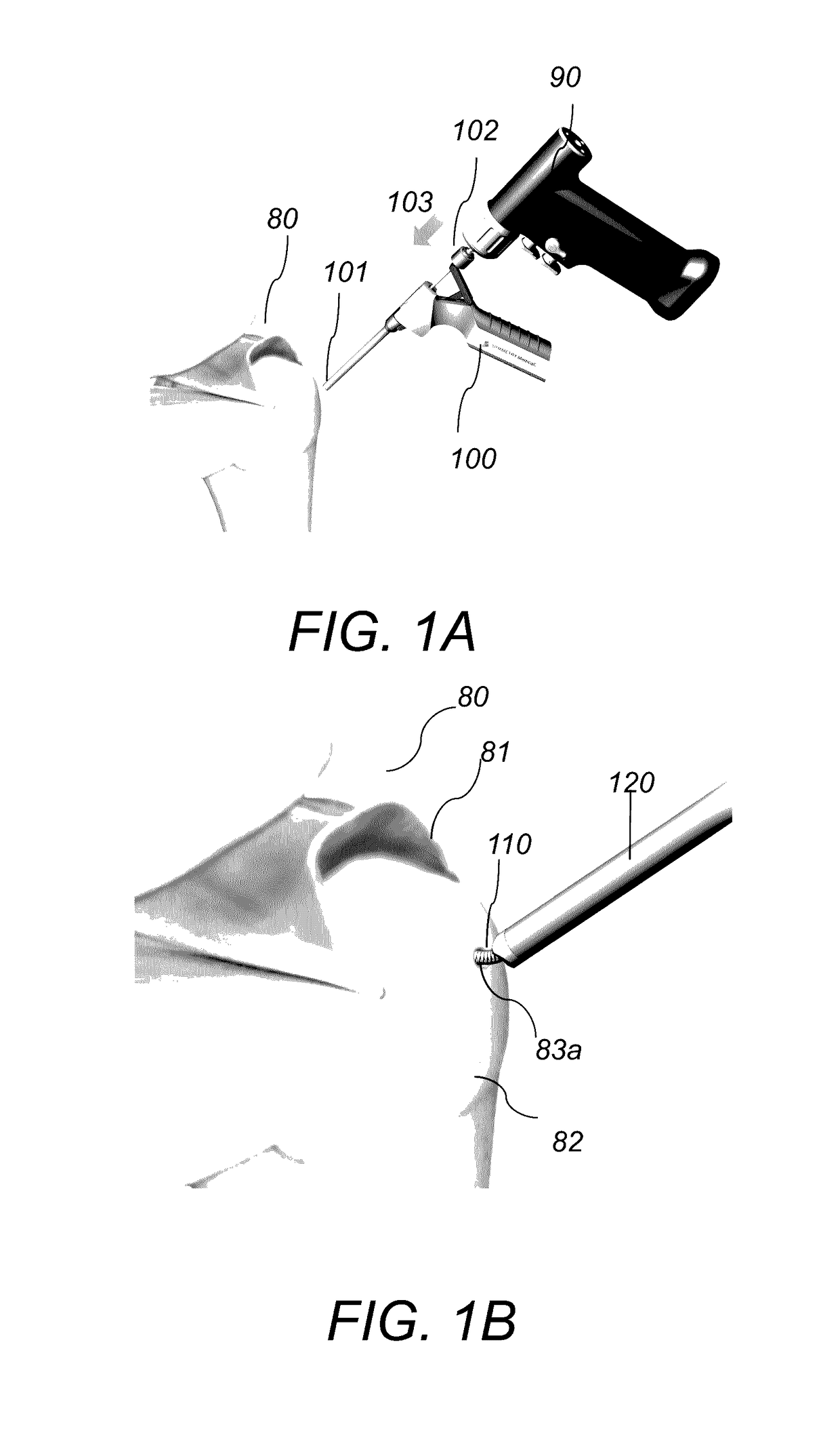 System and method for forming a curved tunnel in bone