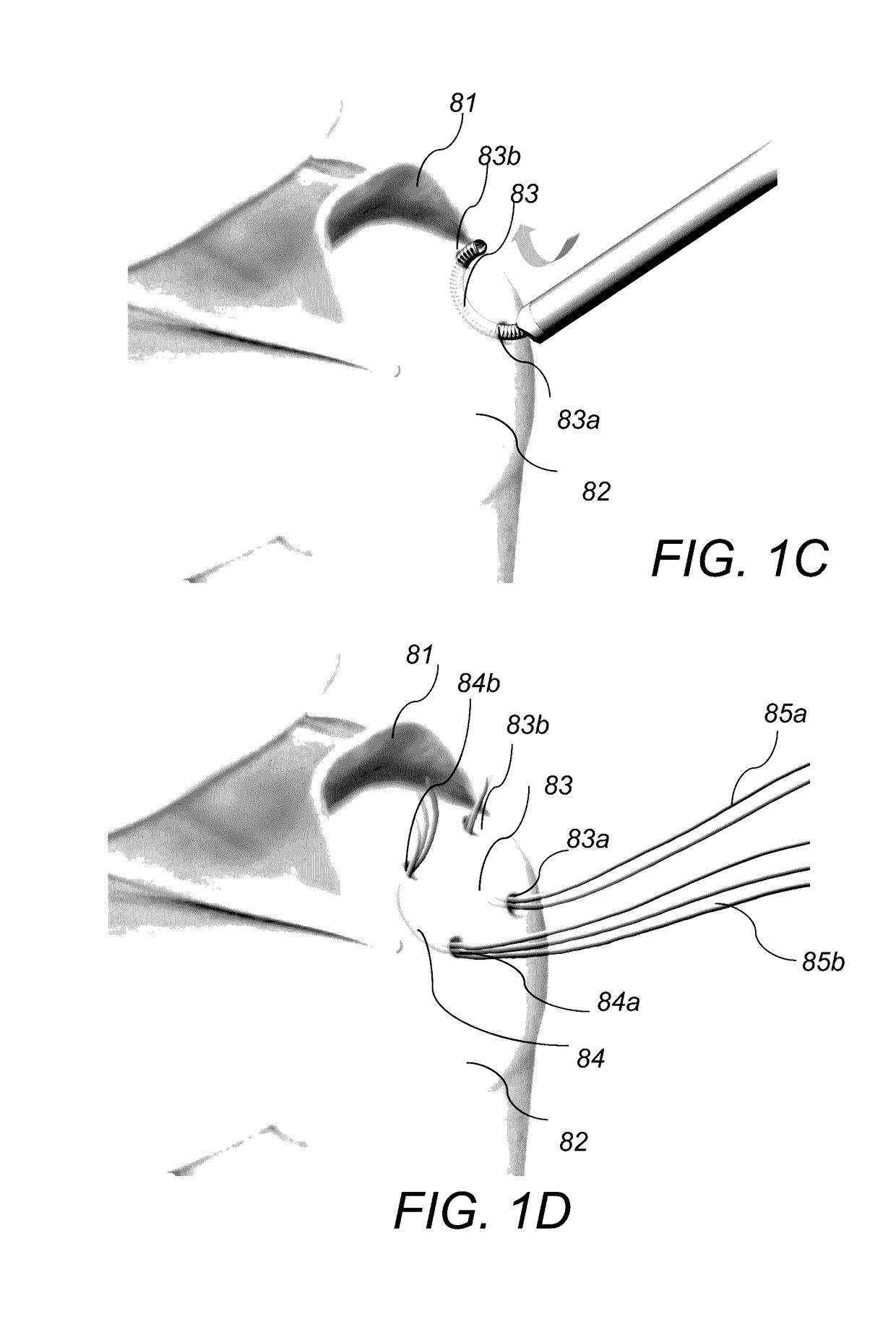 System and method for forming a curved tunnel in bone