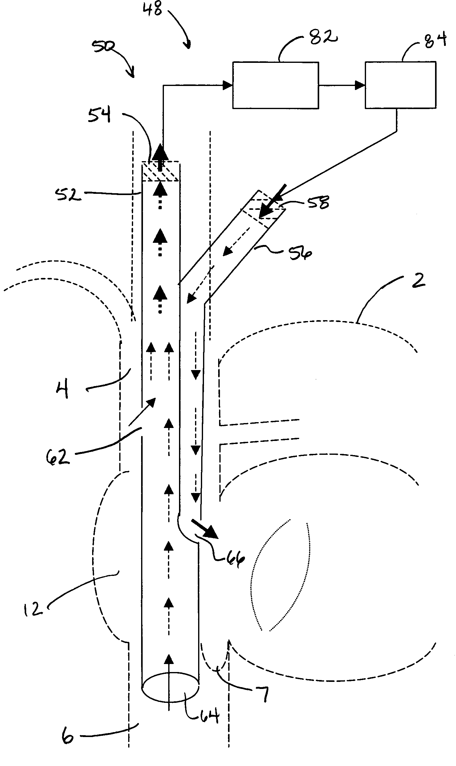 Single expandable double lumen cannula assembly for veno-venous ECMO