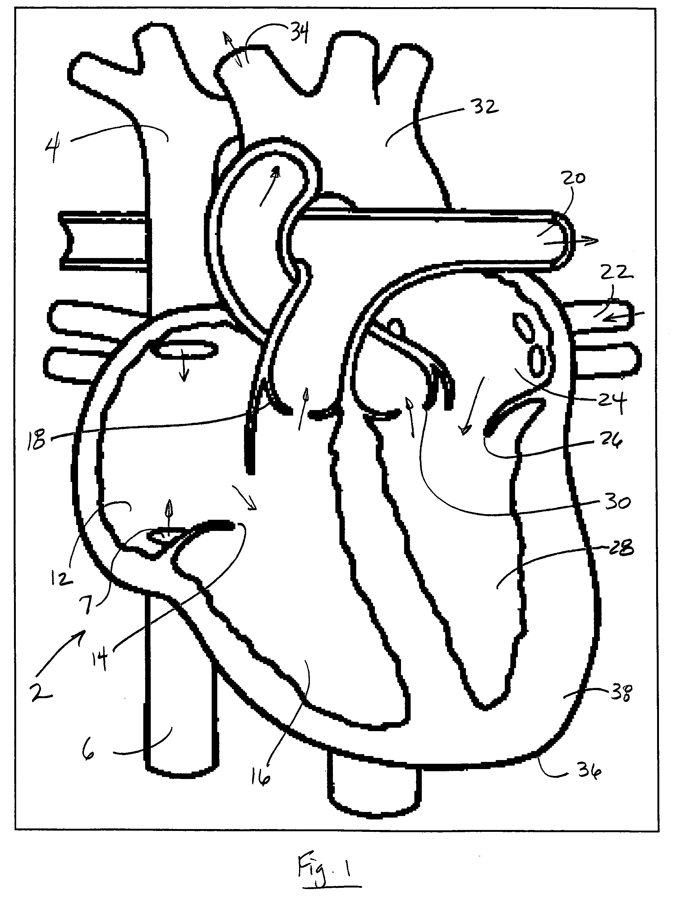 Single expandable double lumen cannula assembly for veno-venous ECMO