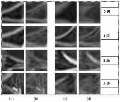 Meniscus injury grading method based on mixed attention weakness supervised transfer learning