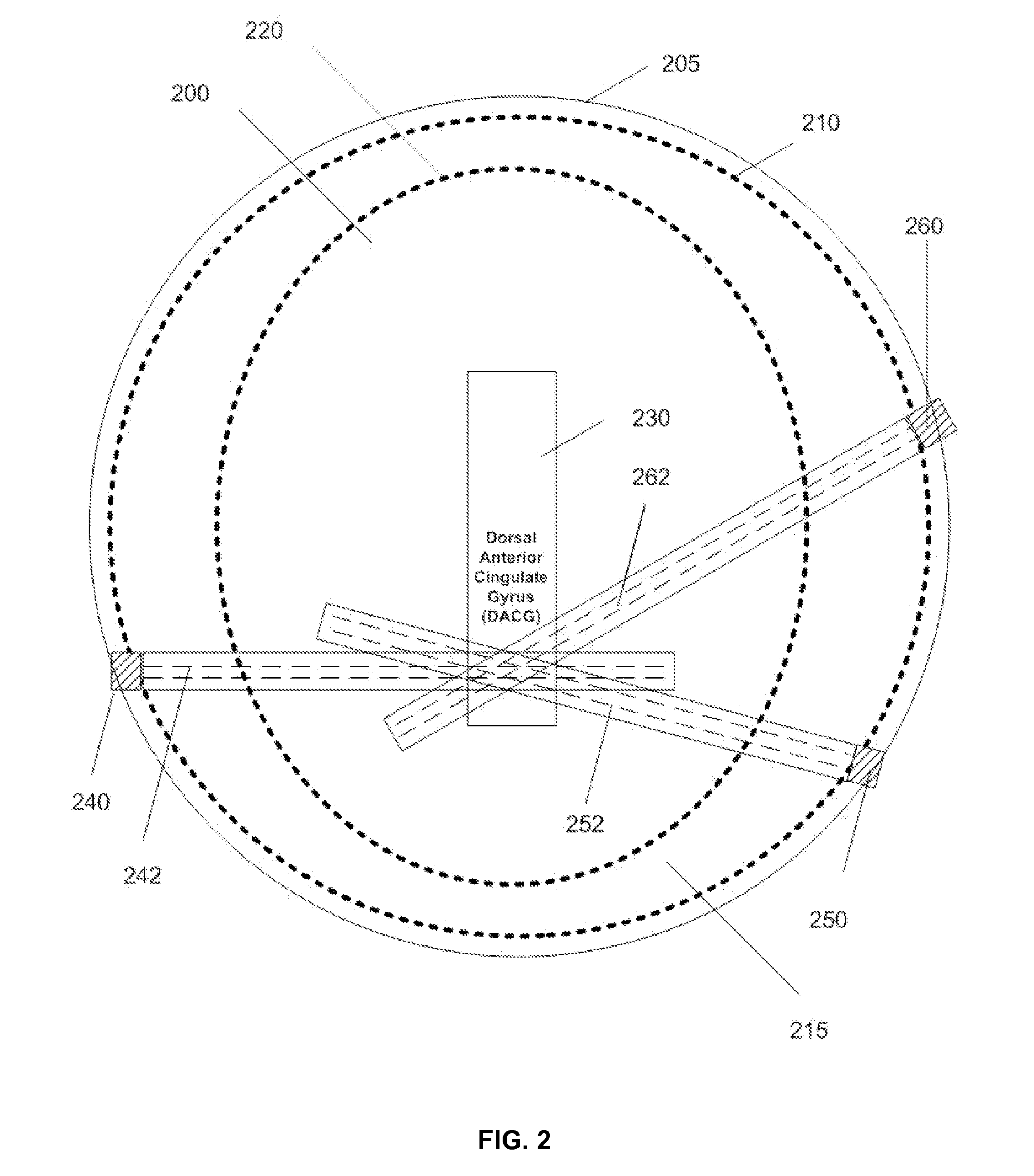 Ultrasound-intersecting beams for deep-brain neuromodulation