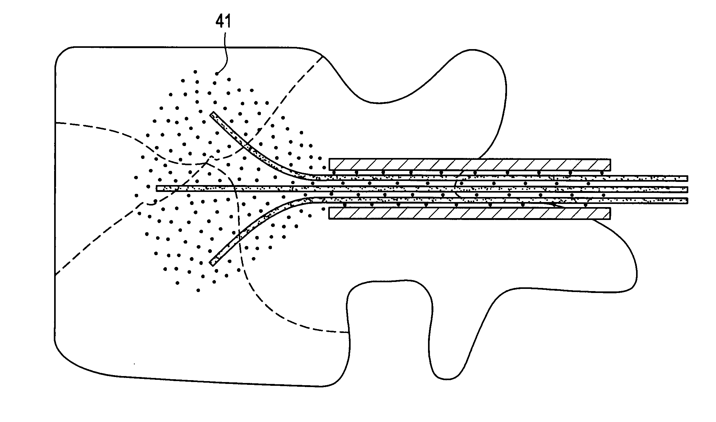 Tissue augmentation, stabilization and regeneration Technique