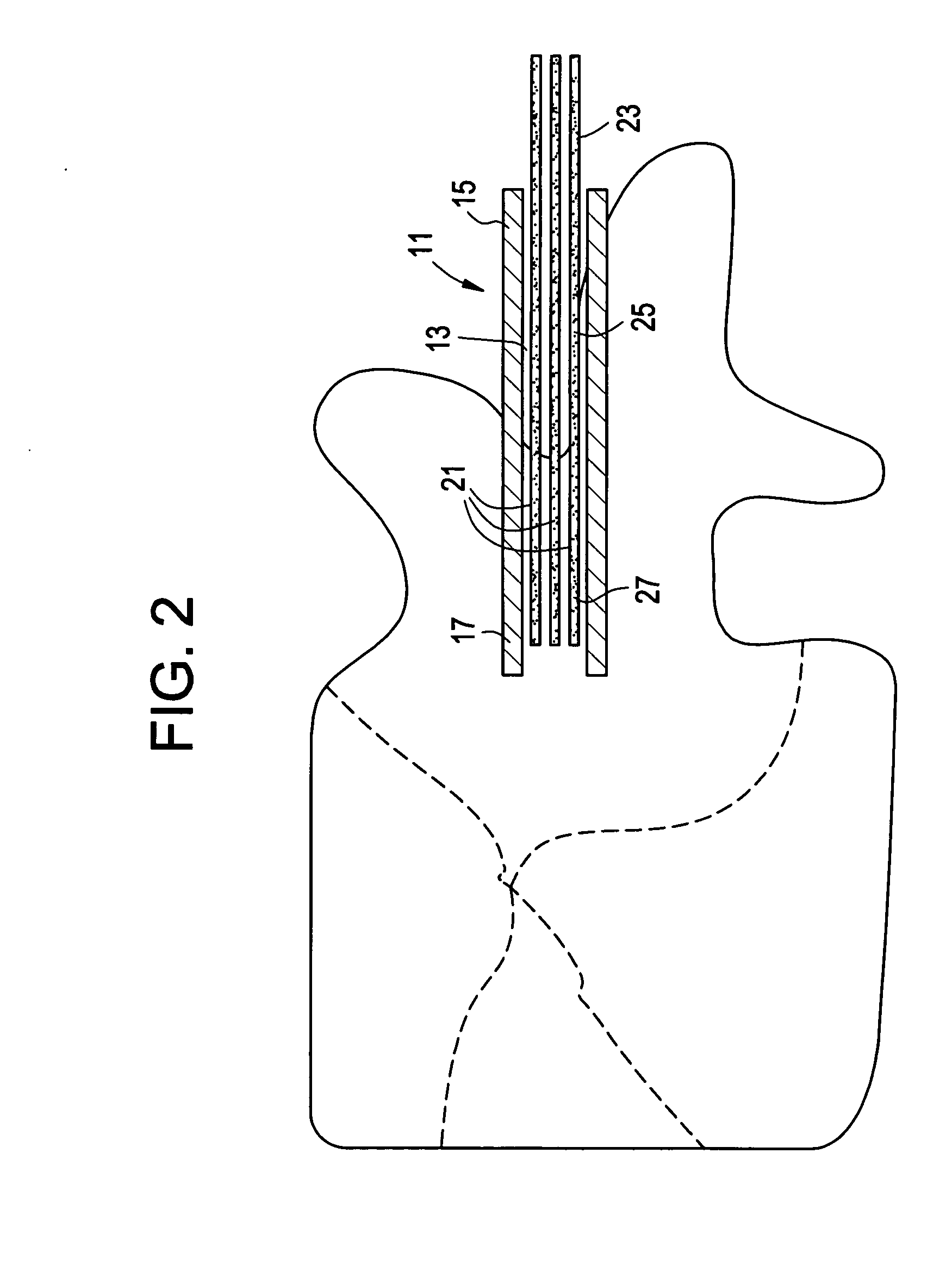 Tissue augmentation, stabilization and regeneration Technique