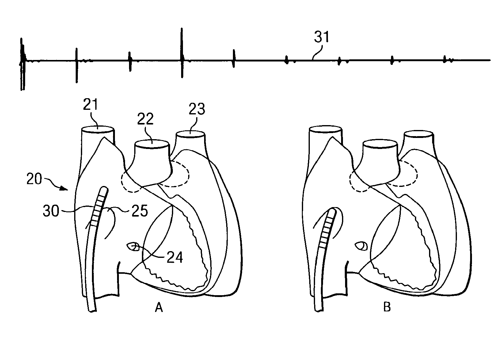 Methods and Apparatus for Locating the Fossa Ovalis and Performing Transseptal Puncture