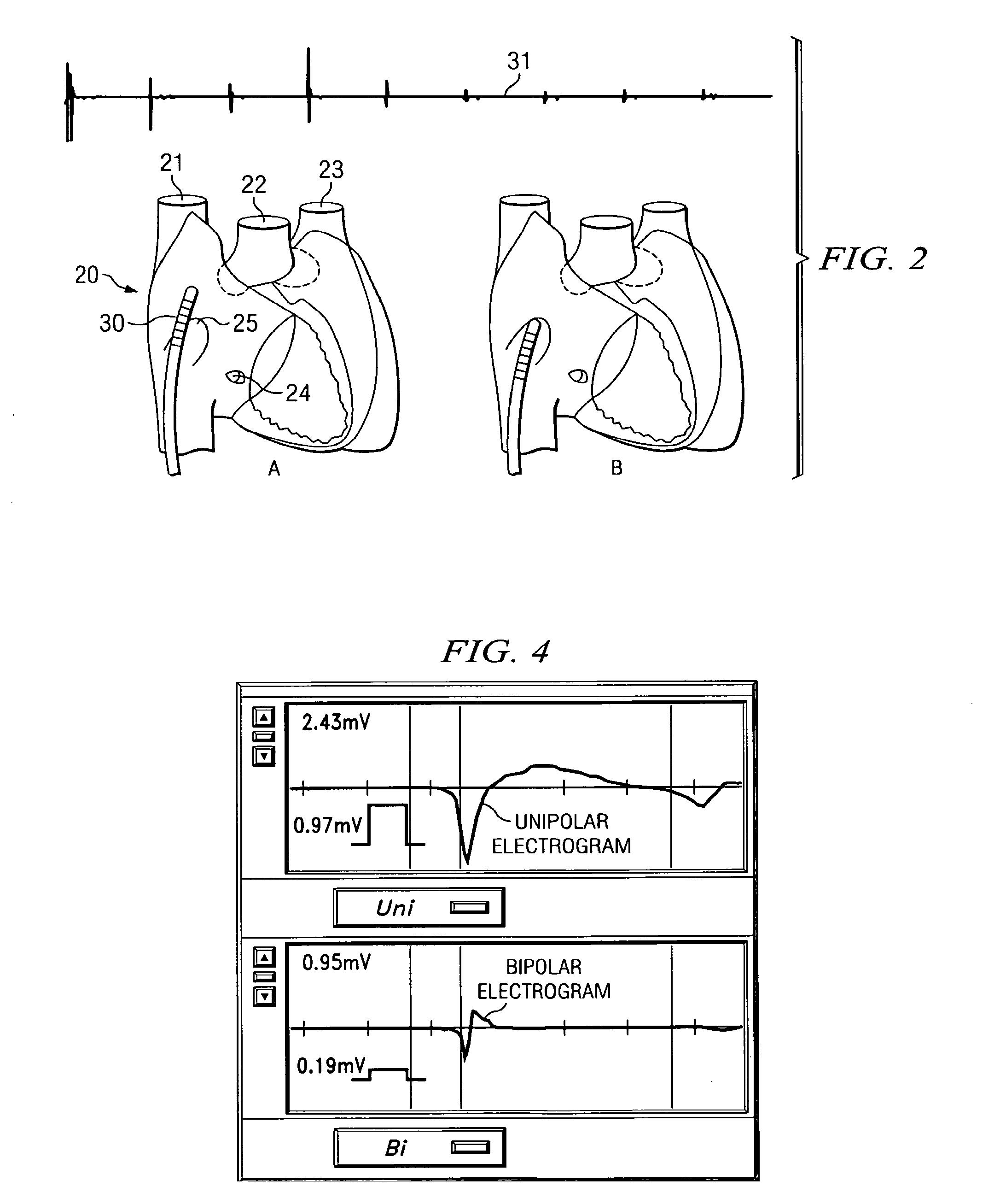 Methods and Apparatus for Locating the Fossa Ovalis and Performing Transseptal Puncture