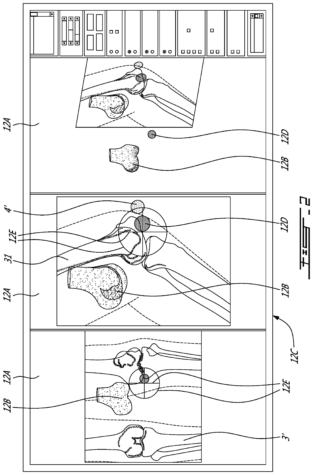 Method and system for pre-operative implant sizing