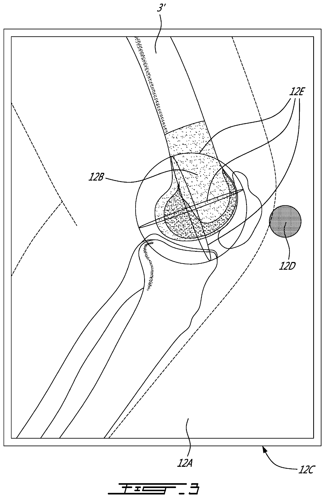 Method and system for pre-operative implant sizing