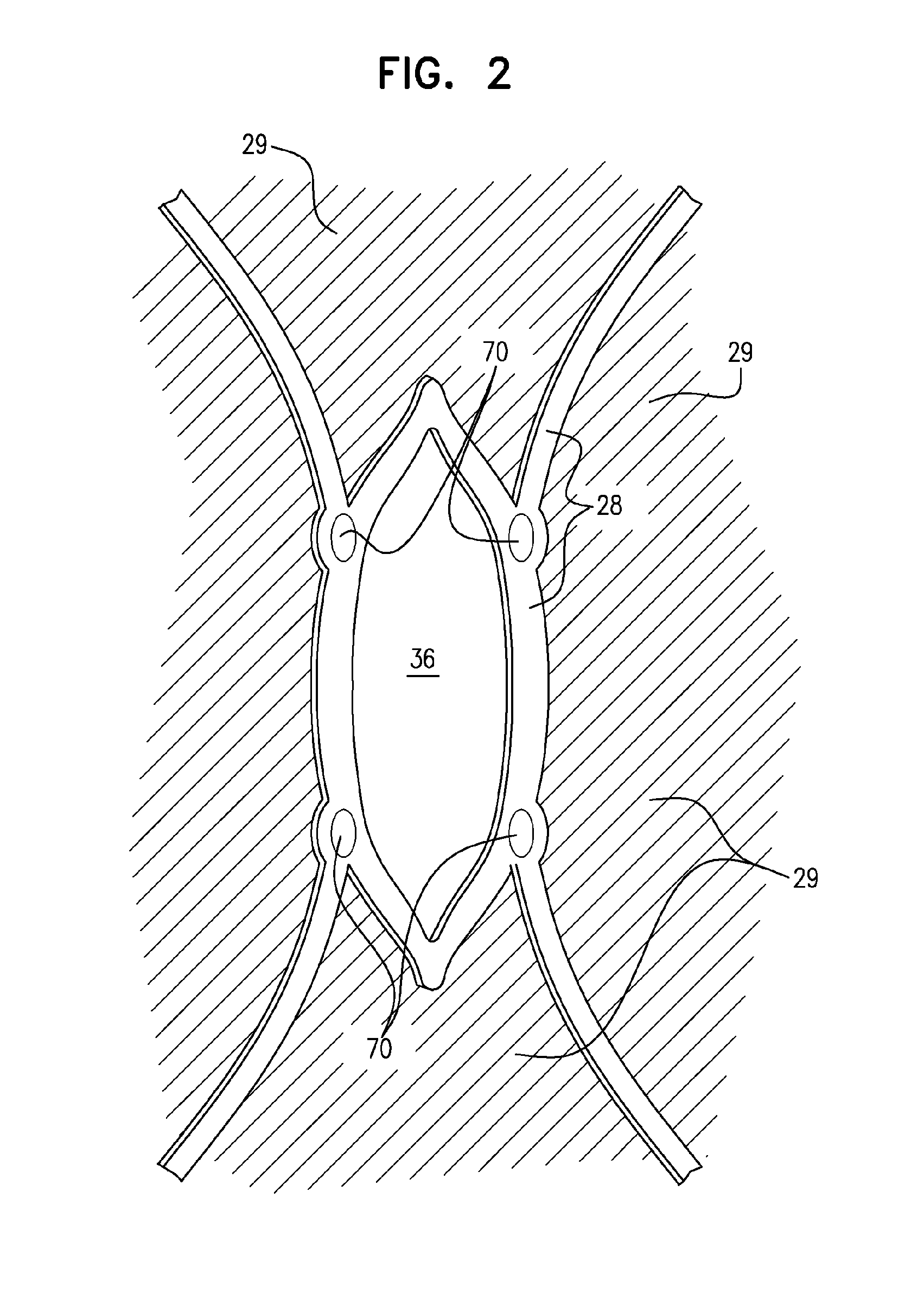 Branched stent-graft system