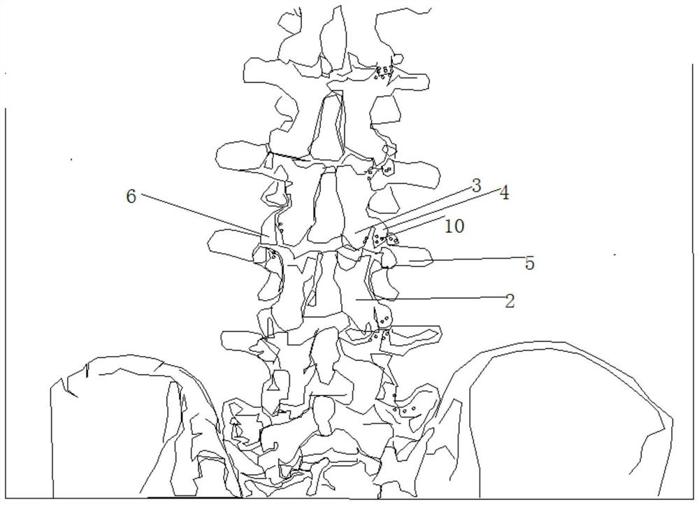 Simulation lumbar vertebra model for training low-age orthopedist to find optimal screw feeding point of lumbar pedicle screw and manufacturing method