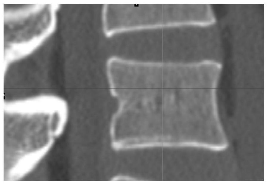 Simulation lumbar vertebra model for training low-age orthopedist to find optimal screw feeding point of lumbar pedicle screw and manufacturing method