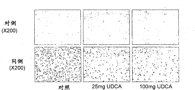 Neuroprotective effect of solubilized UDCA in focal ischemic model