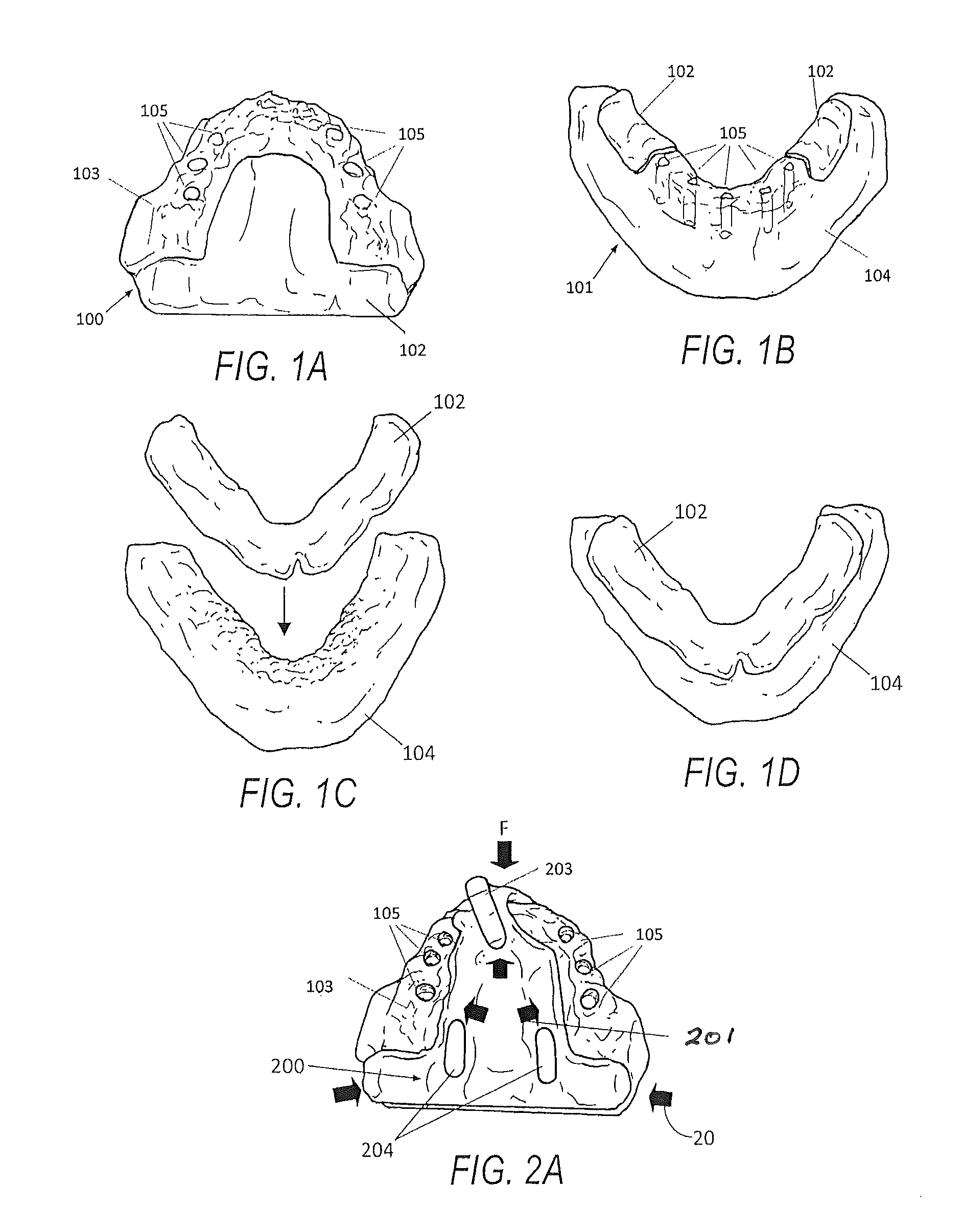 Edentulous surgical guide