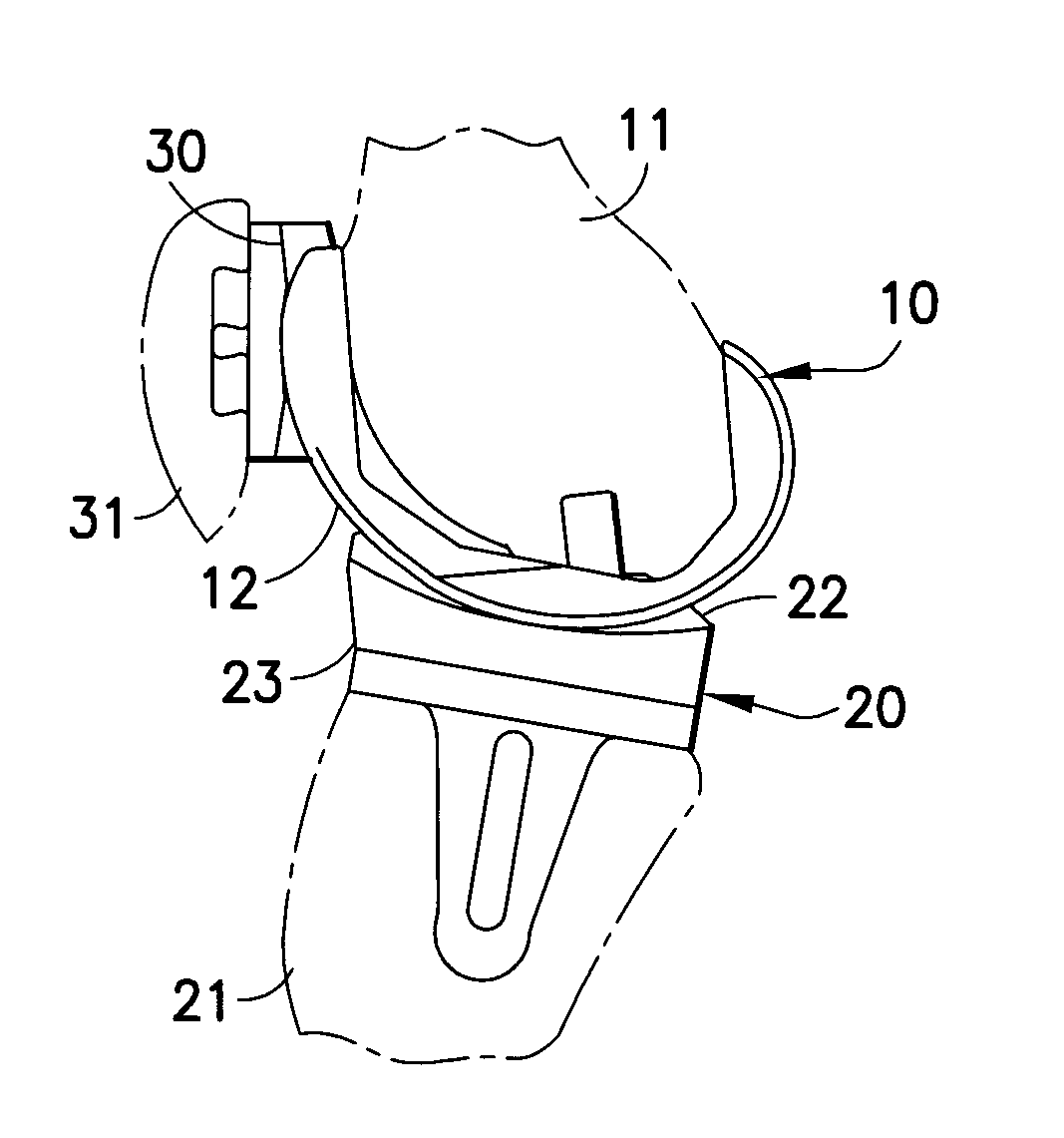 Fixed bearing joint endoprosthesis with combined congruent - incongruent prosthetic articulations