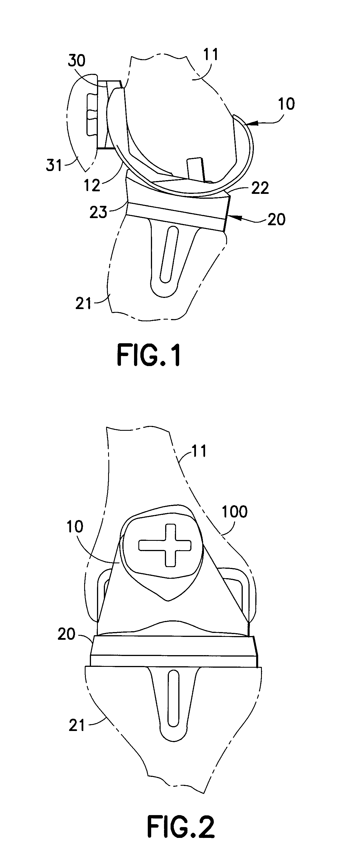 Fixed bearing joint endoprosthesis with combined congruent - incongruent prosthetic articulations