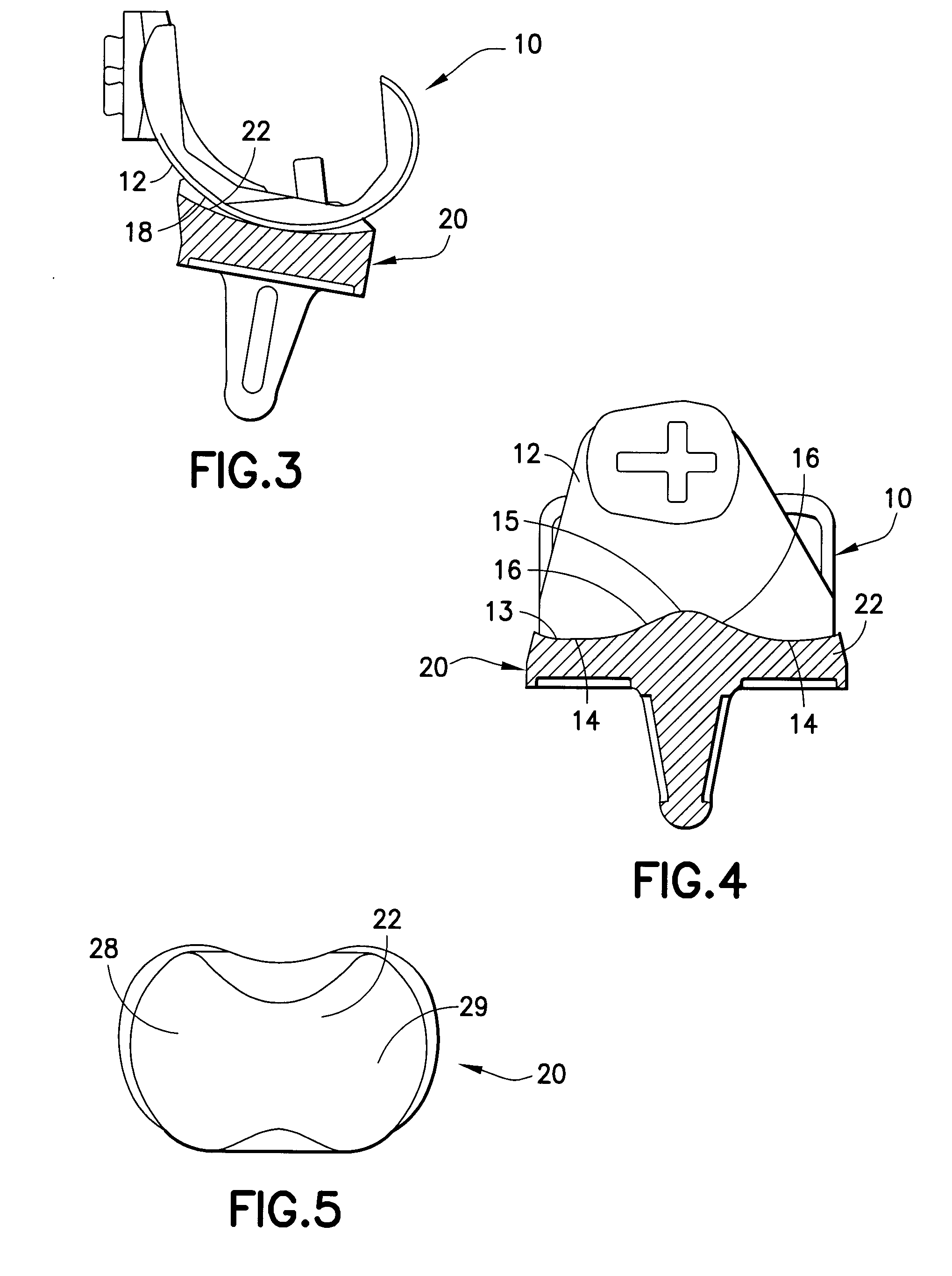 Fixed bearing joint endoprosthesis with combined congruent - incongruent prosthetic articulations