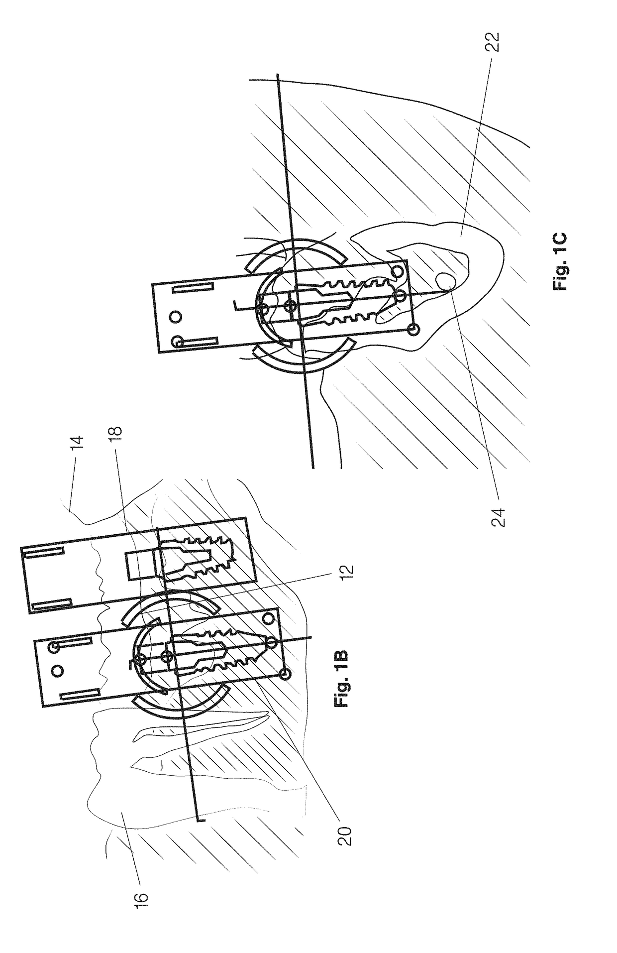 Guided drill, kit of guided drills and methods of osteotomy for inserting a dental implant using the kit