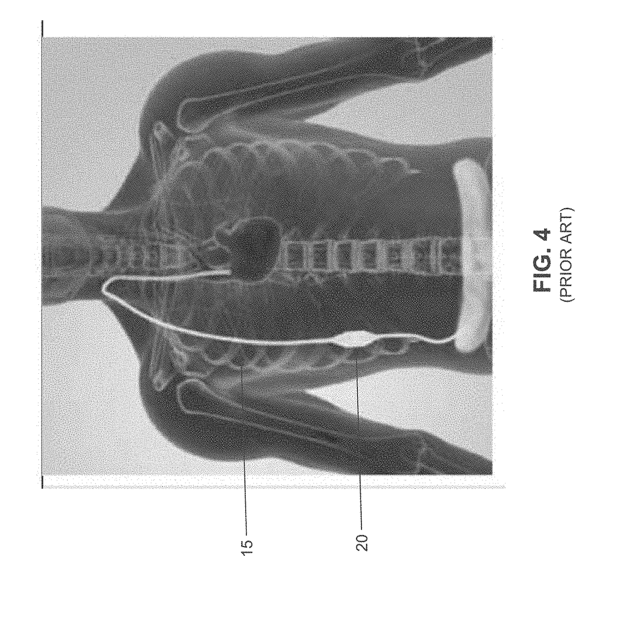 Method and apparatus for treating fluid build-up in a body cavity, including method and apparatus for treating ascites and pleural effusions