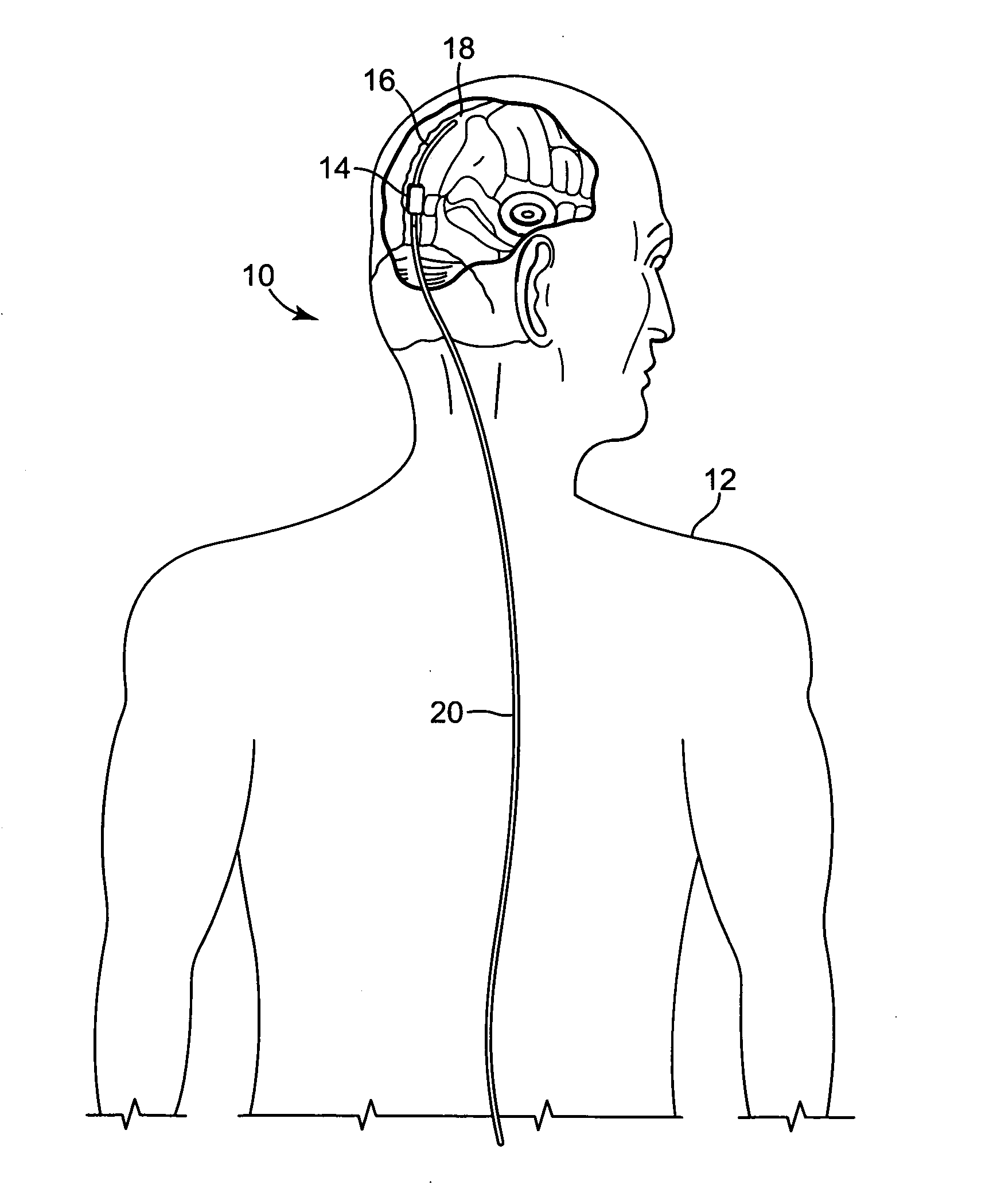 Implantable cerebral spinal fluid flow device and method of controlling flow of cerebral spinal fluid