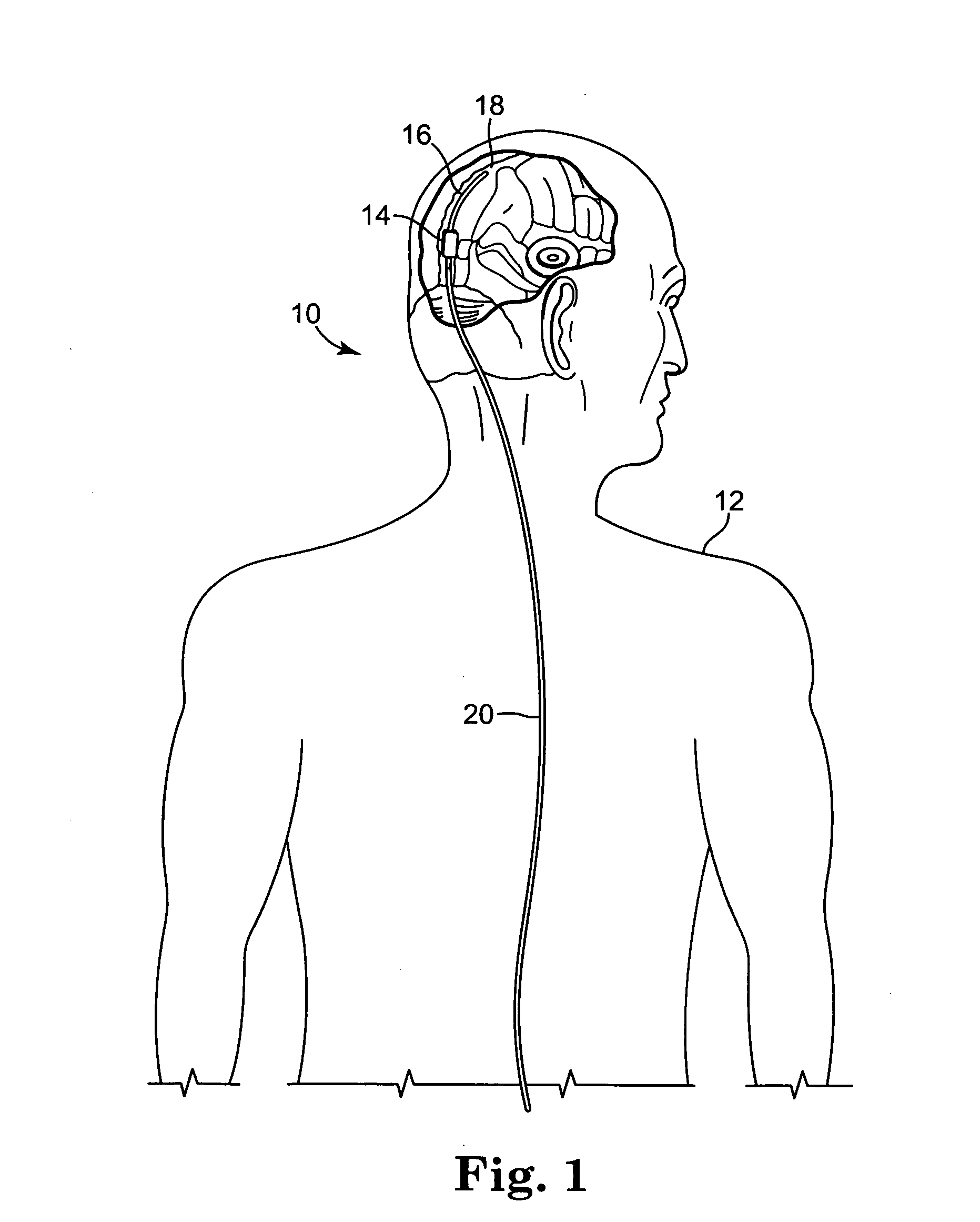 Implantable cerebral spinal fluid flow device and method of controlling flow of cerebral spinal fluid