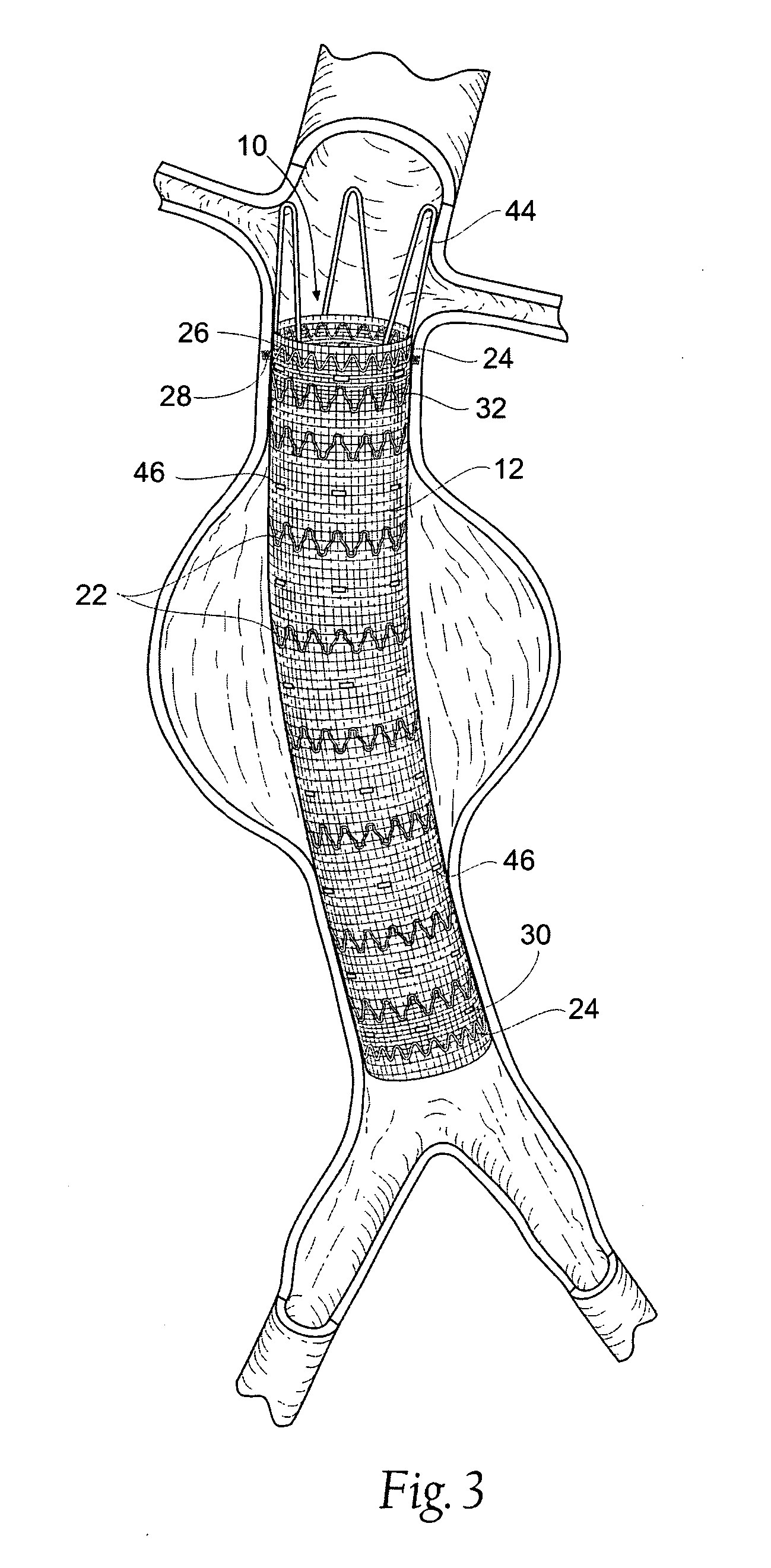 Systems and methods for attaching a prosthesis within a body lumen or hollow organ